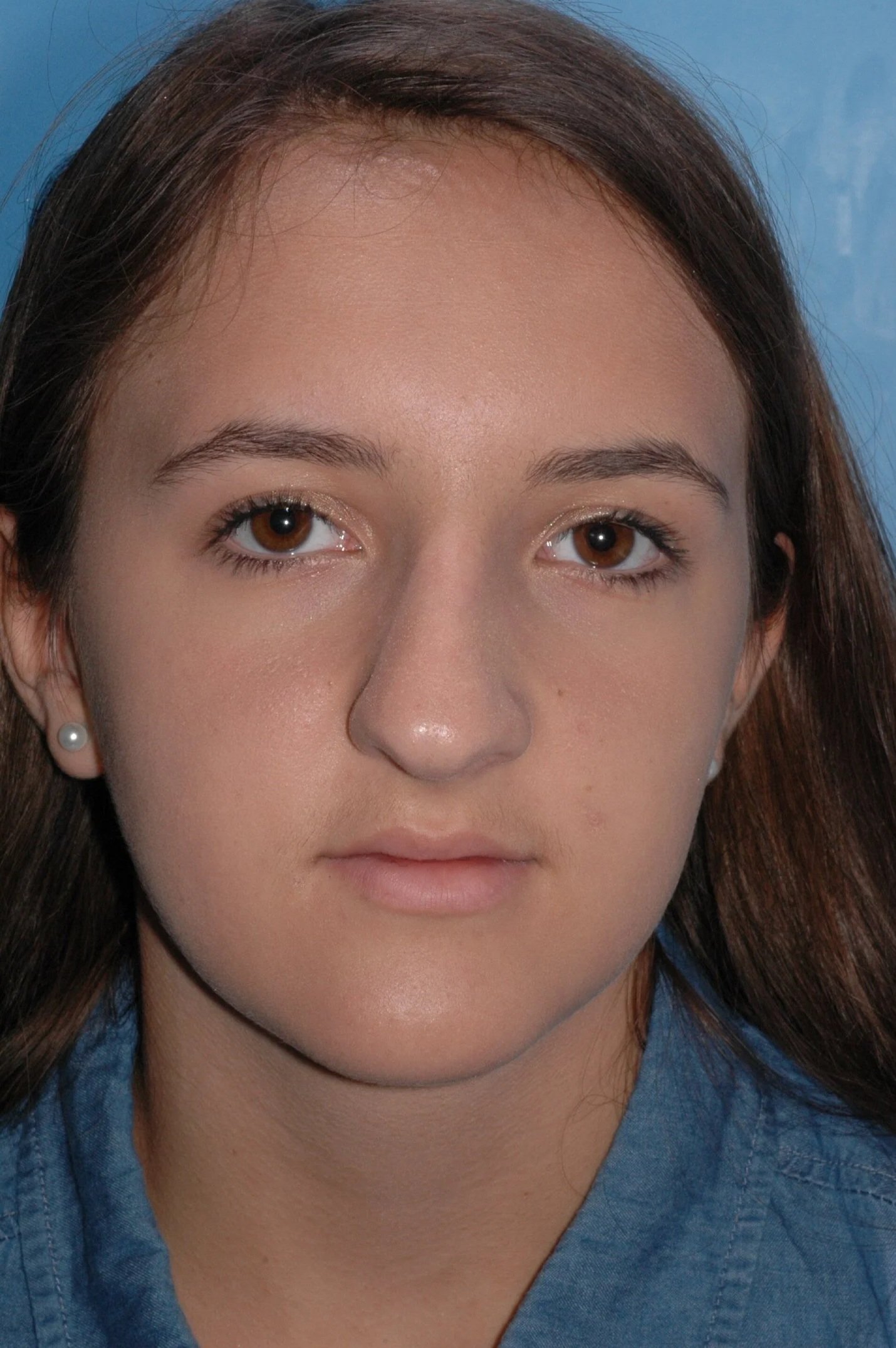 BEFORE rhinoplasty: wide nasal tip, wide dorsum, ptotic tip