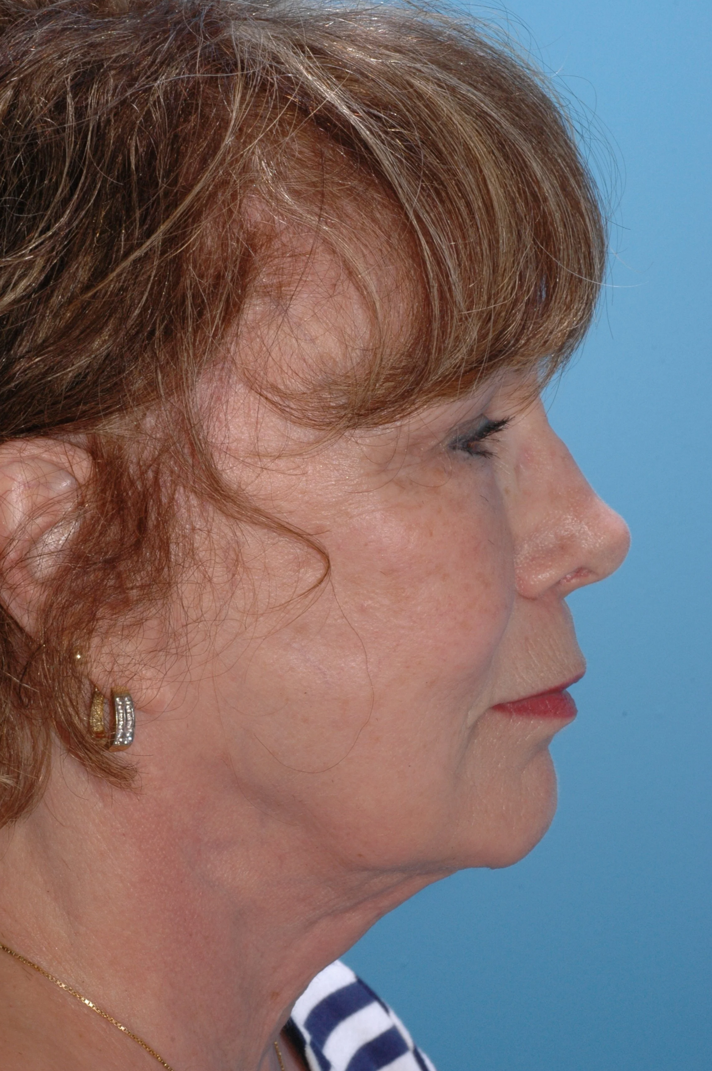 5 y AFTER rhinoplasty: dorsal reduction, medial and lateral osteotomies, tongue-in-groove to recess the medial crus and elevate /rotate tip, onlay graft of cartilage over the superior left nasal tip, L rim graft, 3 mm nasal sill excisions.