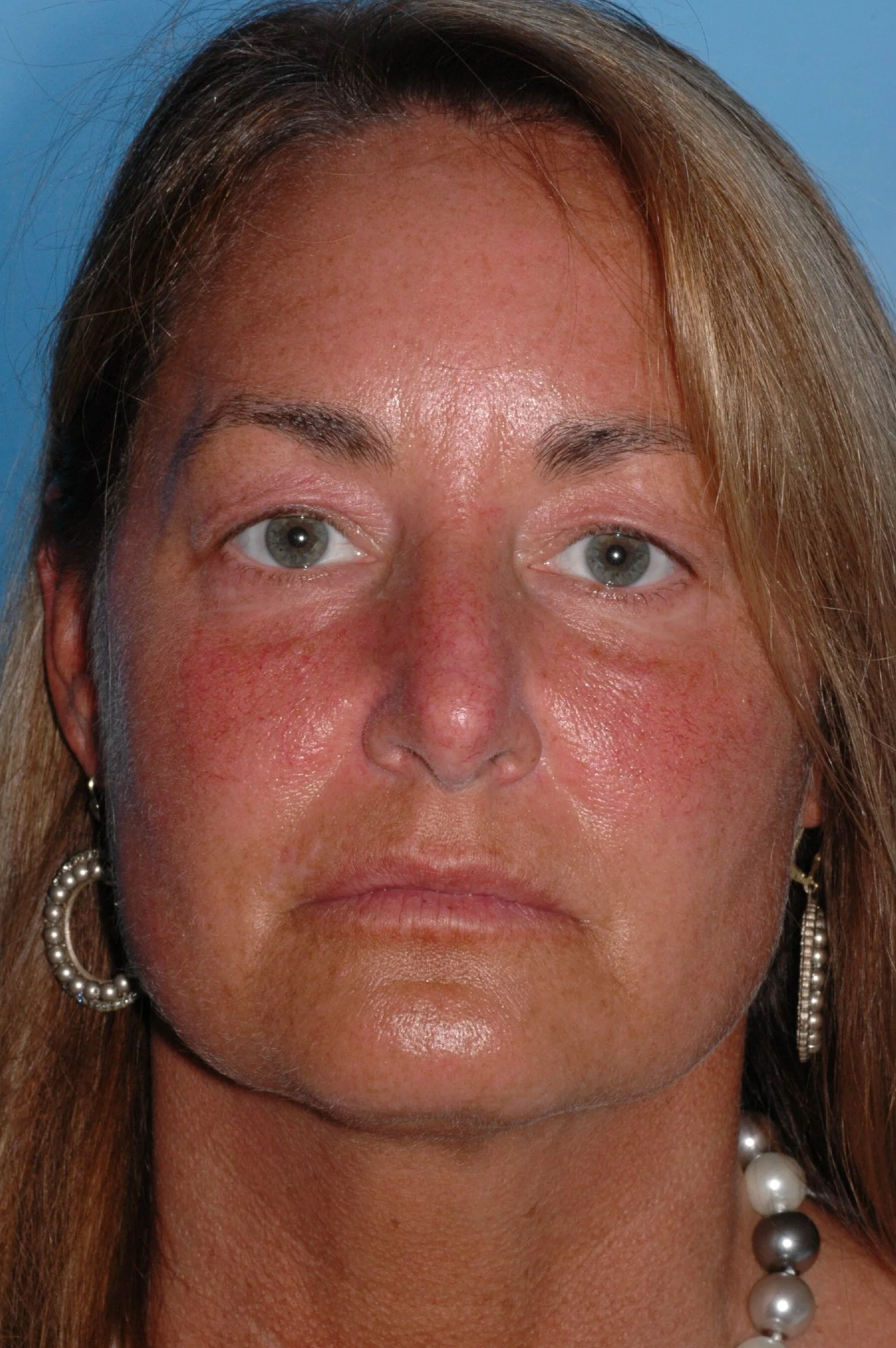 BEFORE upper eyelid blepharoplasty