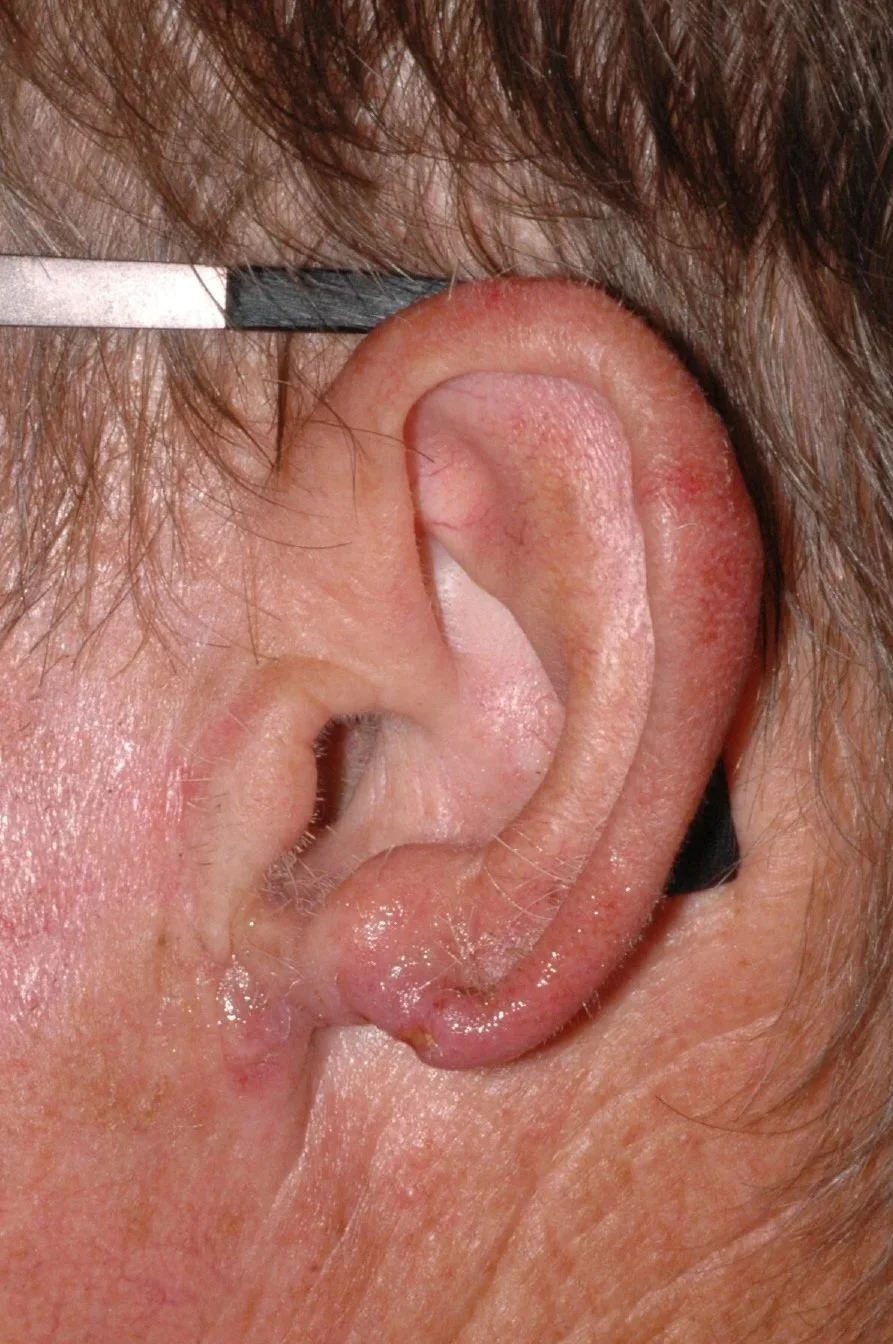 BEFORE: dog bite to ear, with missing earlobe