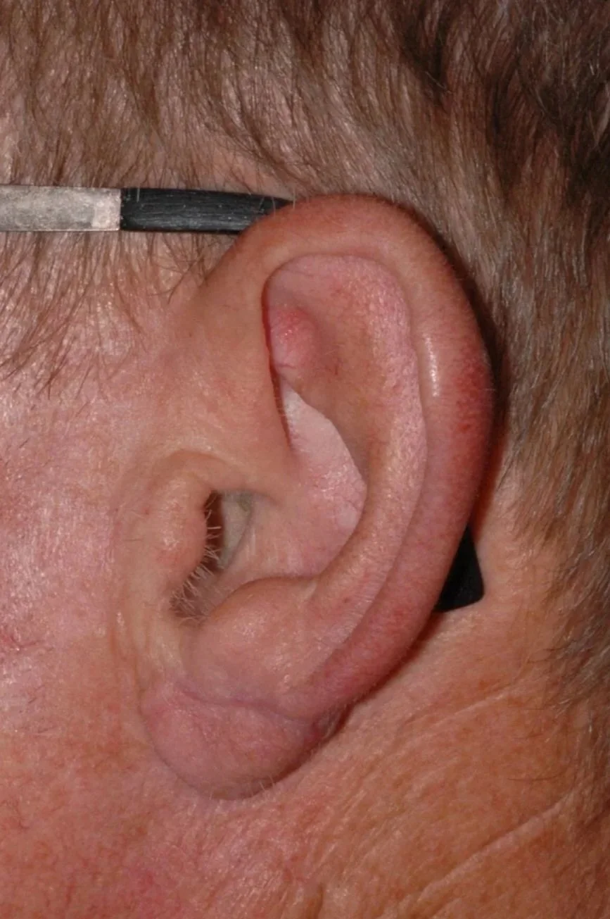 AFTER: 2-stage ear lobe reconstruction with local pedicled flap and auricular cartilage