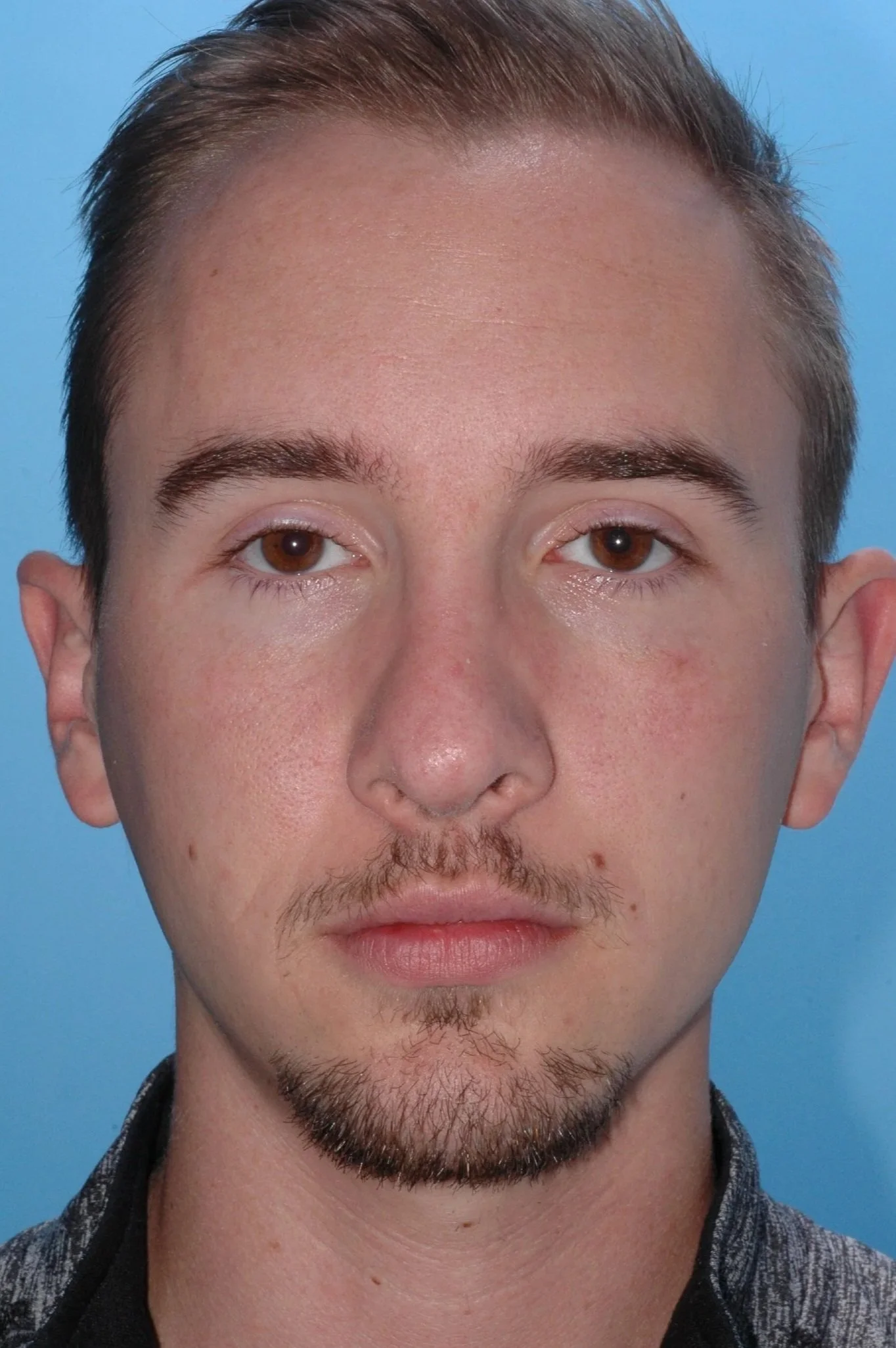 AFTER rhinoplasty: Double PDS
foil placed on the left side after weakening the cartilage to conform to it, nasal dorsum reduced, L cephalic turn-in, R cephalic trim, .
1.5 mm lateral crural overlap, bossae
softened over right tip-defining point, crus