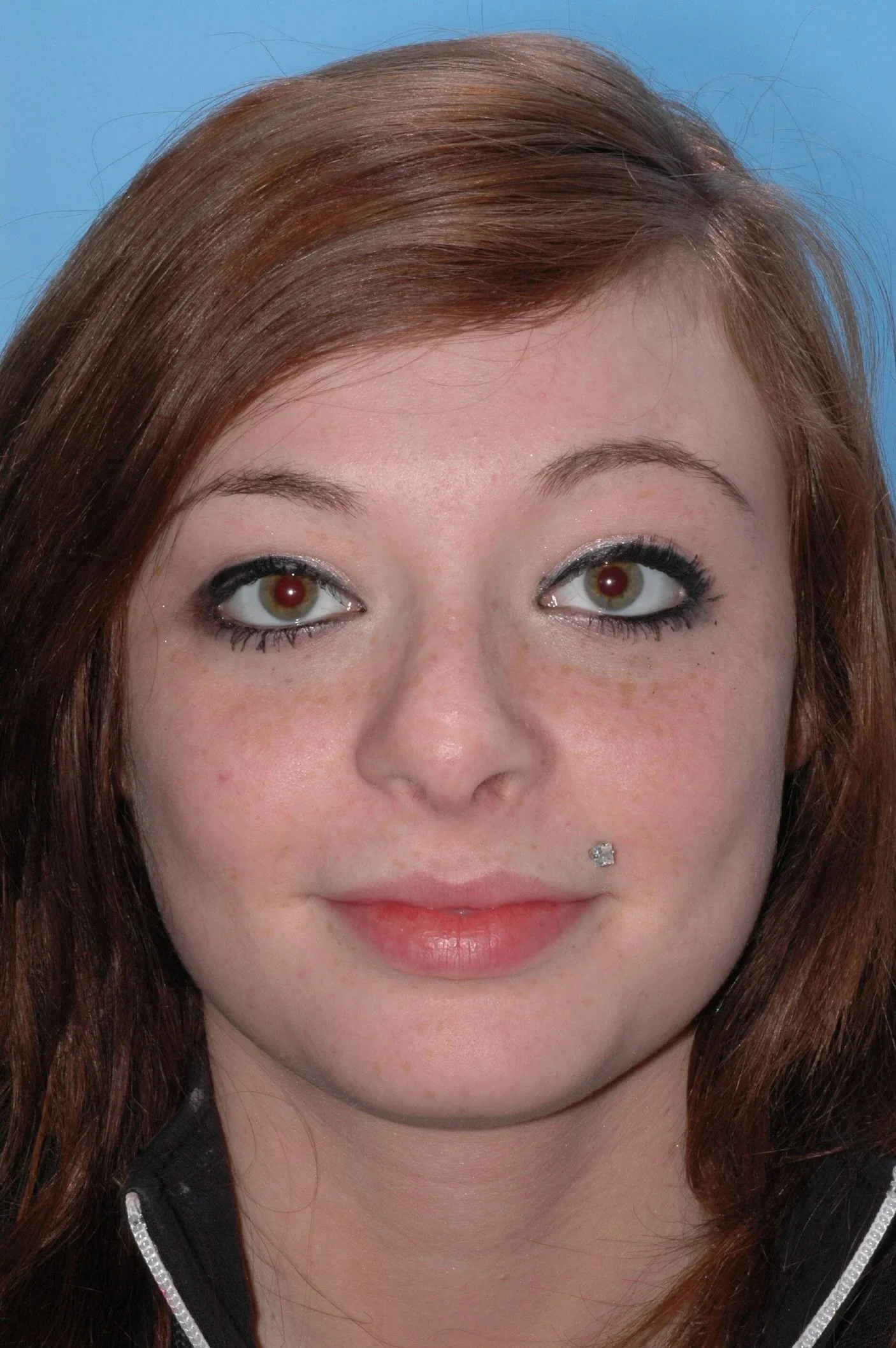 AFTER rhinoplasty