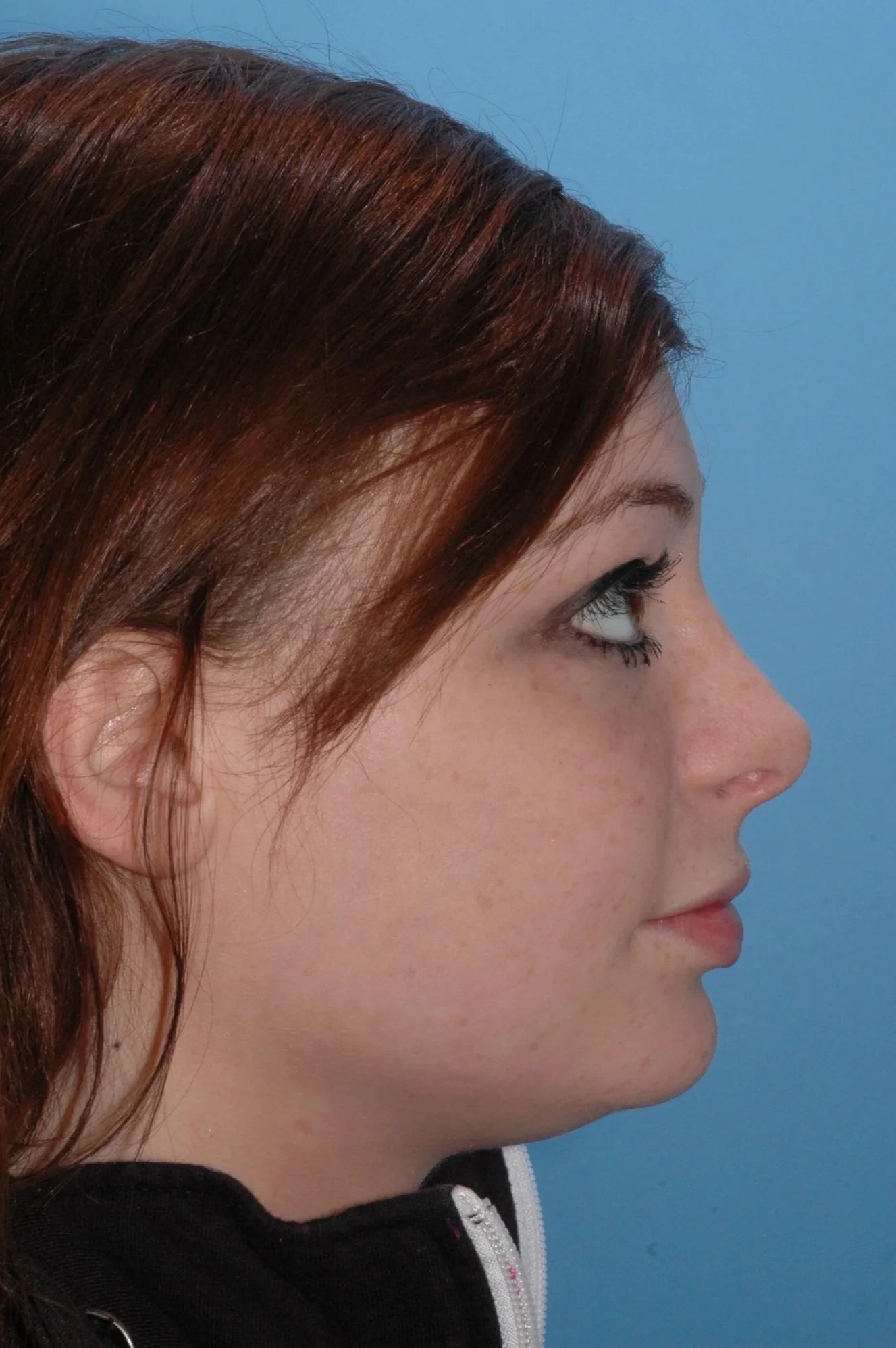 AFTER rhinoplasty