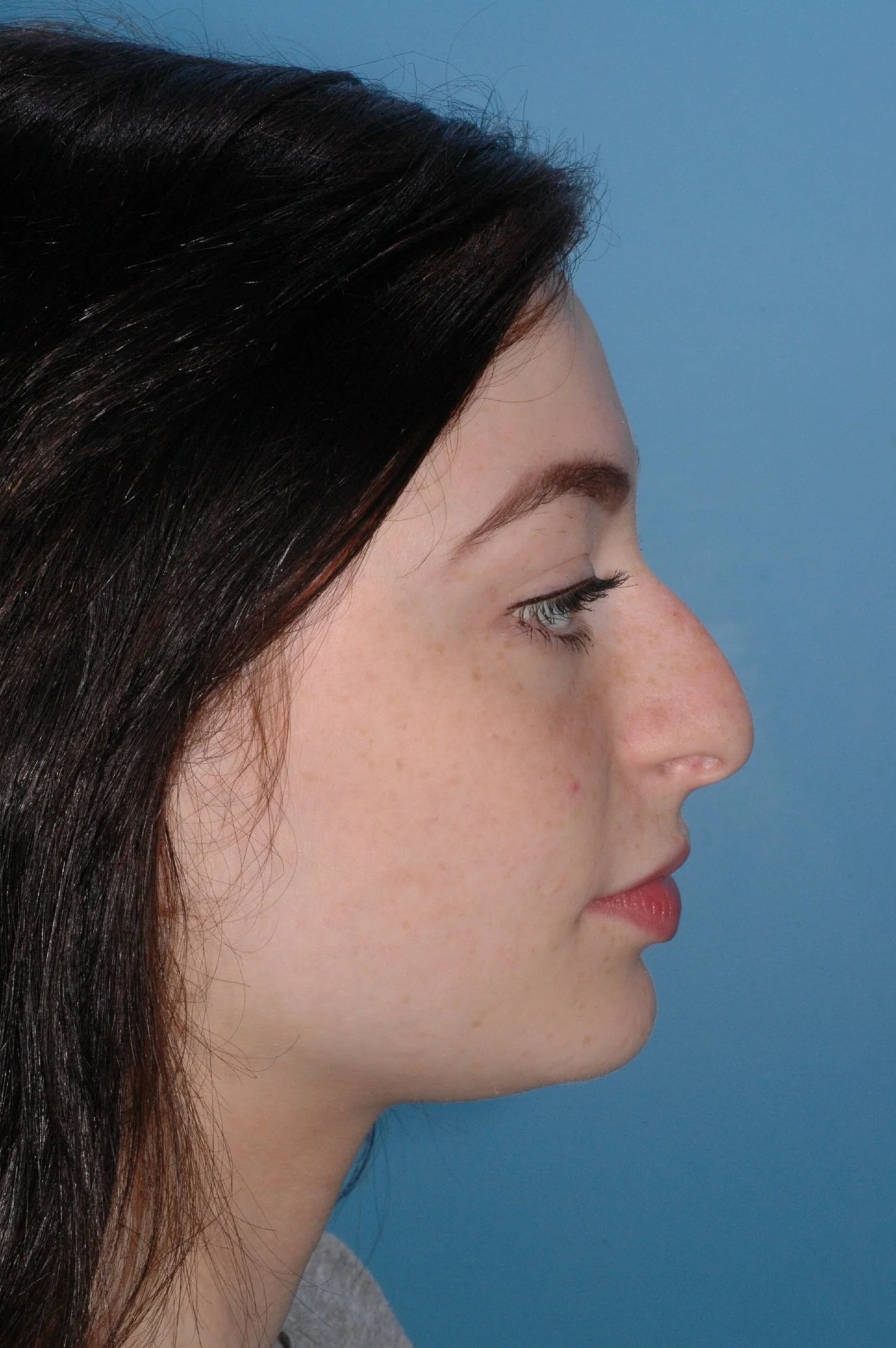 BEFORE rhinoplasty: droopy nasal tip, nasal hump