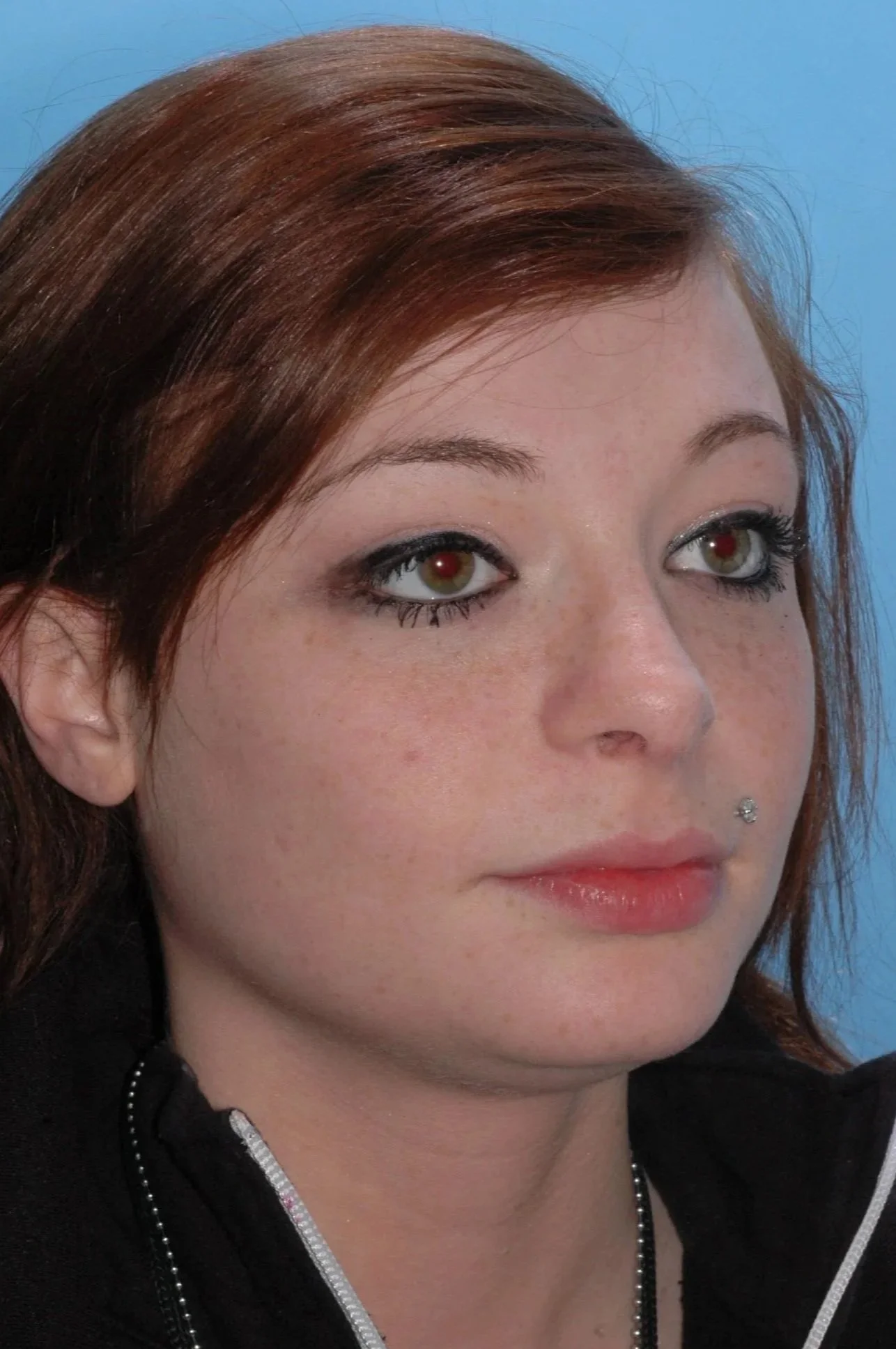 AFTER rhinoplasty