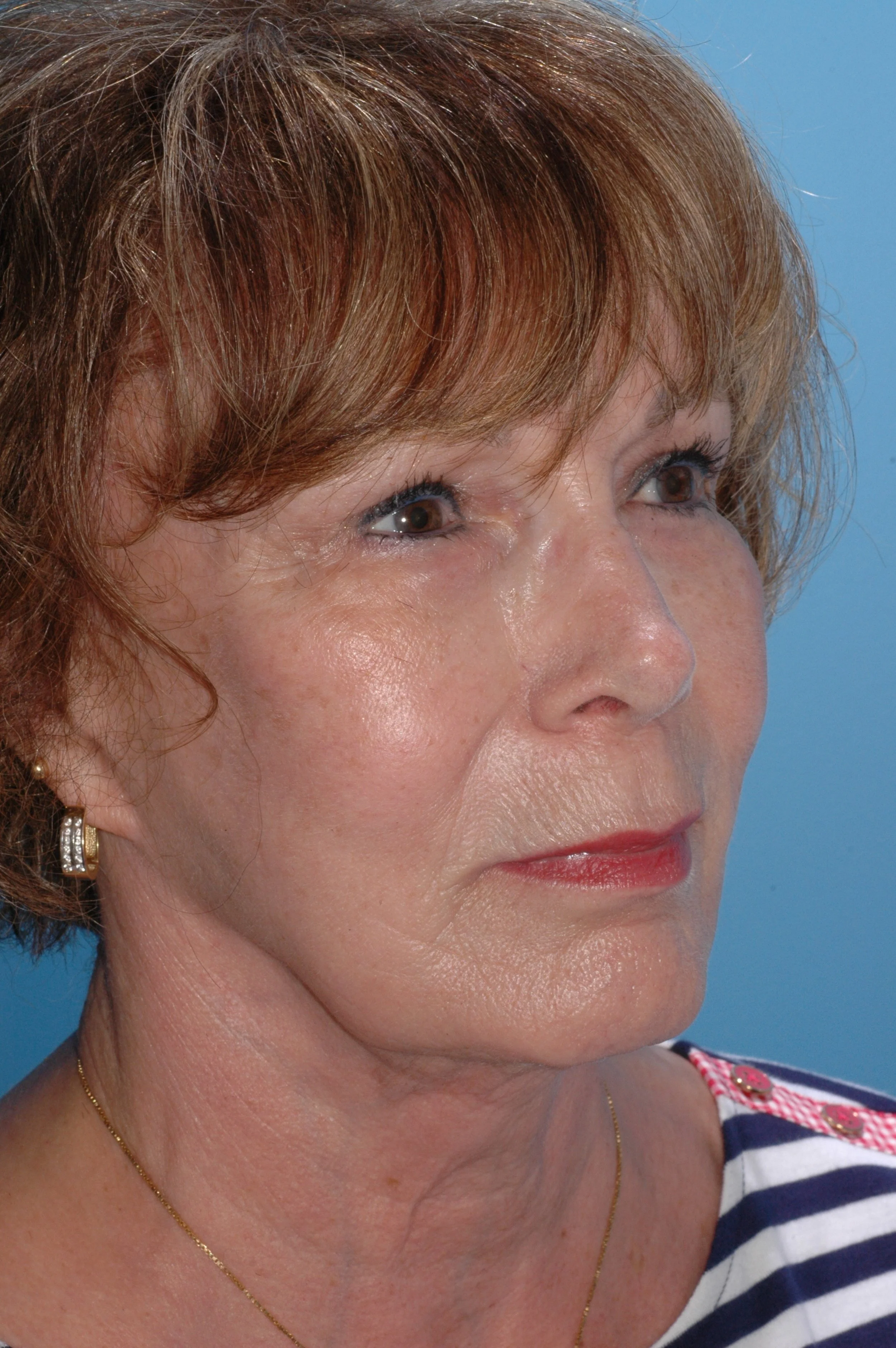 5 y AFTER rhinoplasty: dorsal reduction, medial and lateral osteotomies, tongue-in-groove to recess the medial crus and elevate /rotate tip, onlay graft of cartilage over the superior left nasal tip, L rim graft, 3 mm nasal sill excisions.