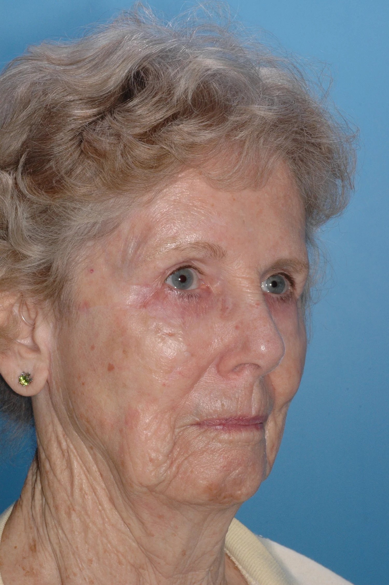 1 y AFTER: cervical facial rotation flap