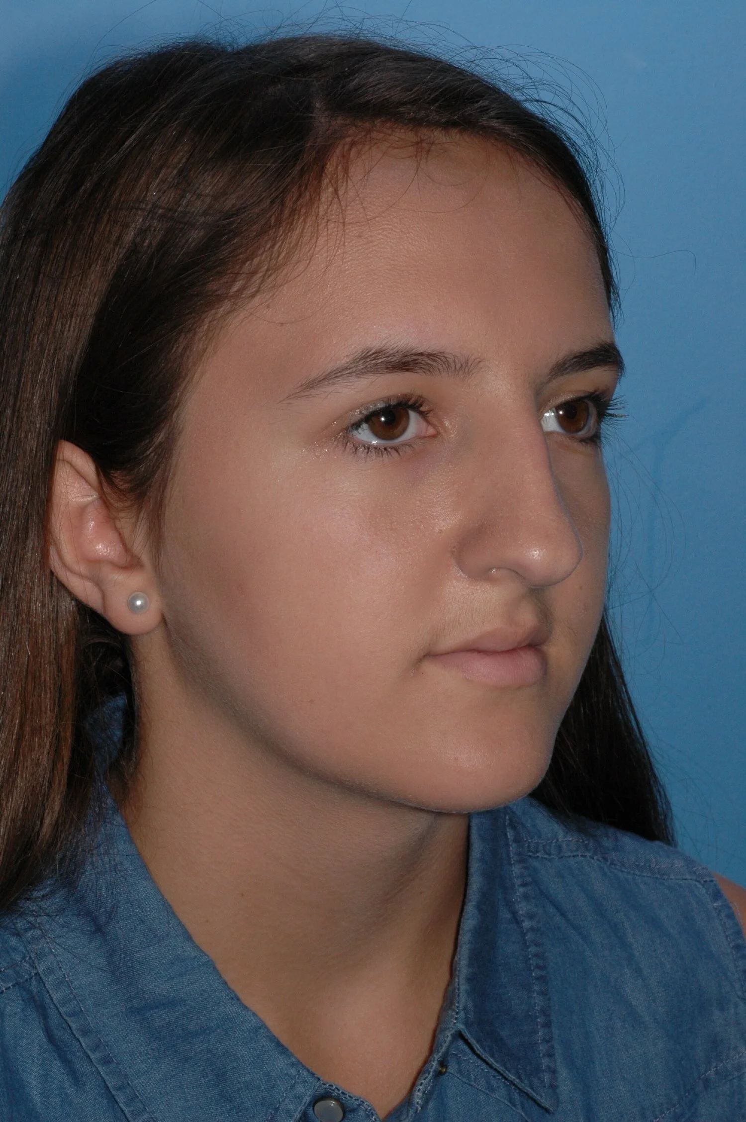 BEFORE rhinoplasty: wide nasal tip, wide dorsum, ptotic tip