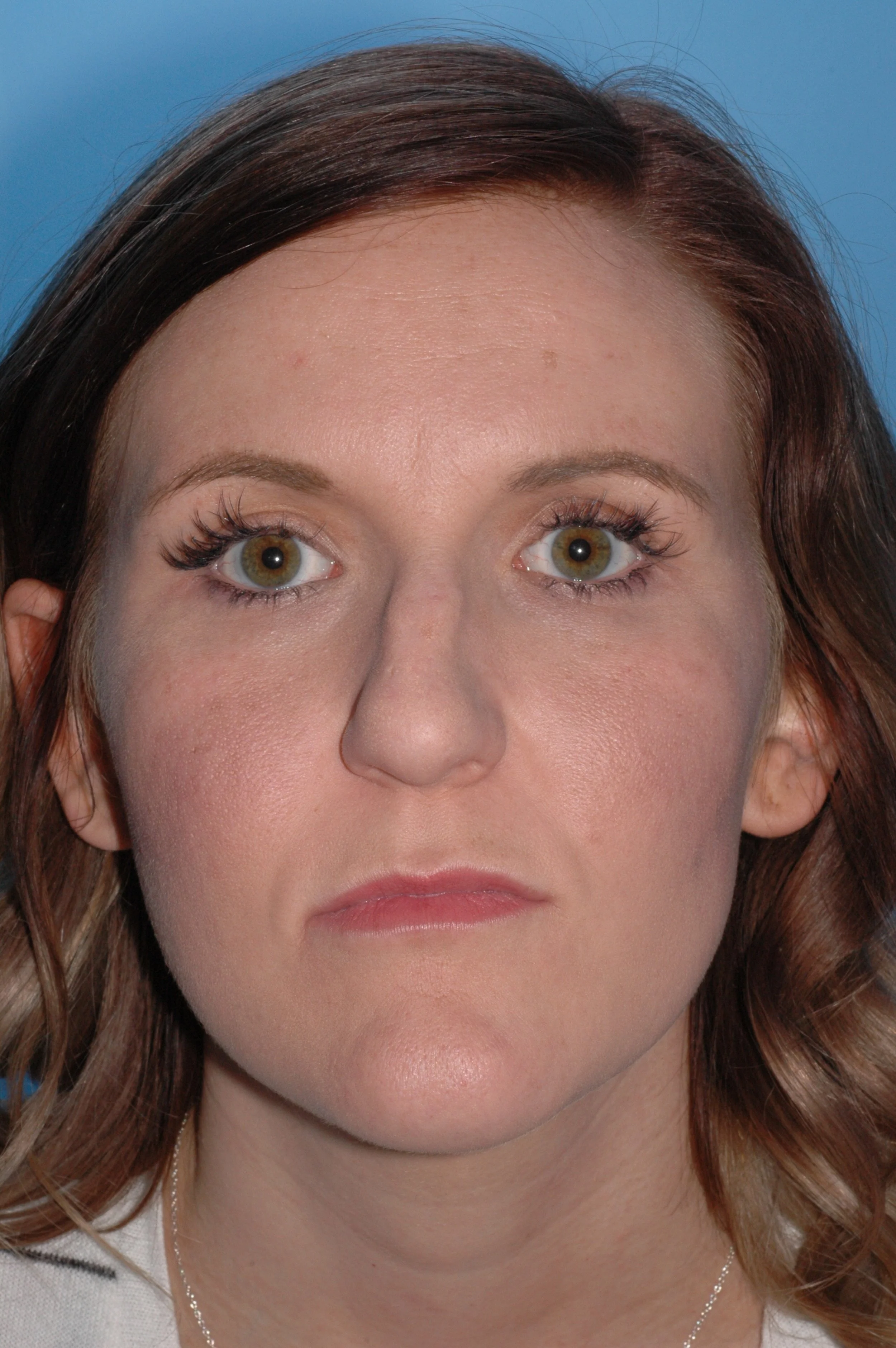 BEFORE: Crooked nose, hump dorsum