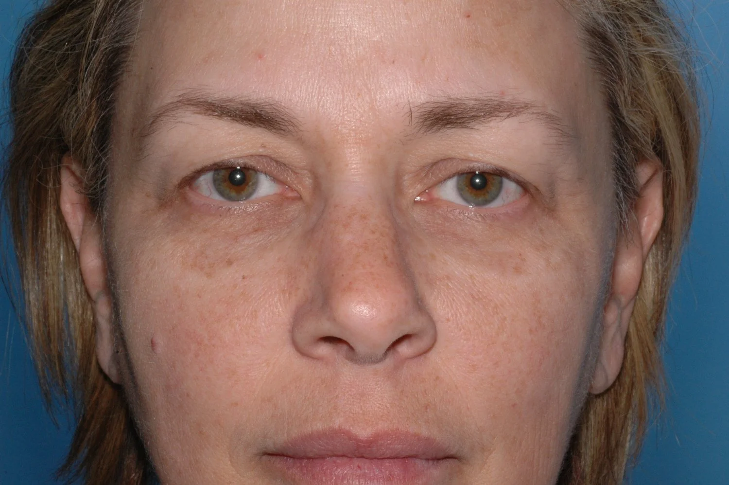 BEFORE Upper lid blepharoplasty