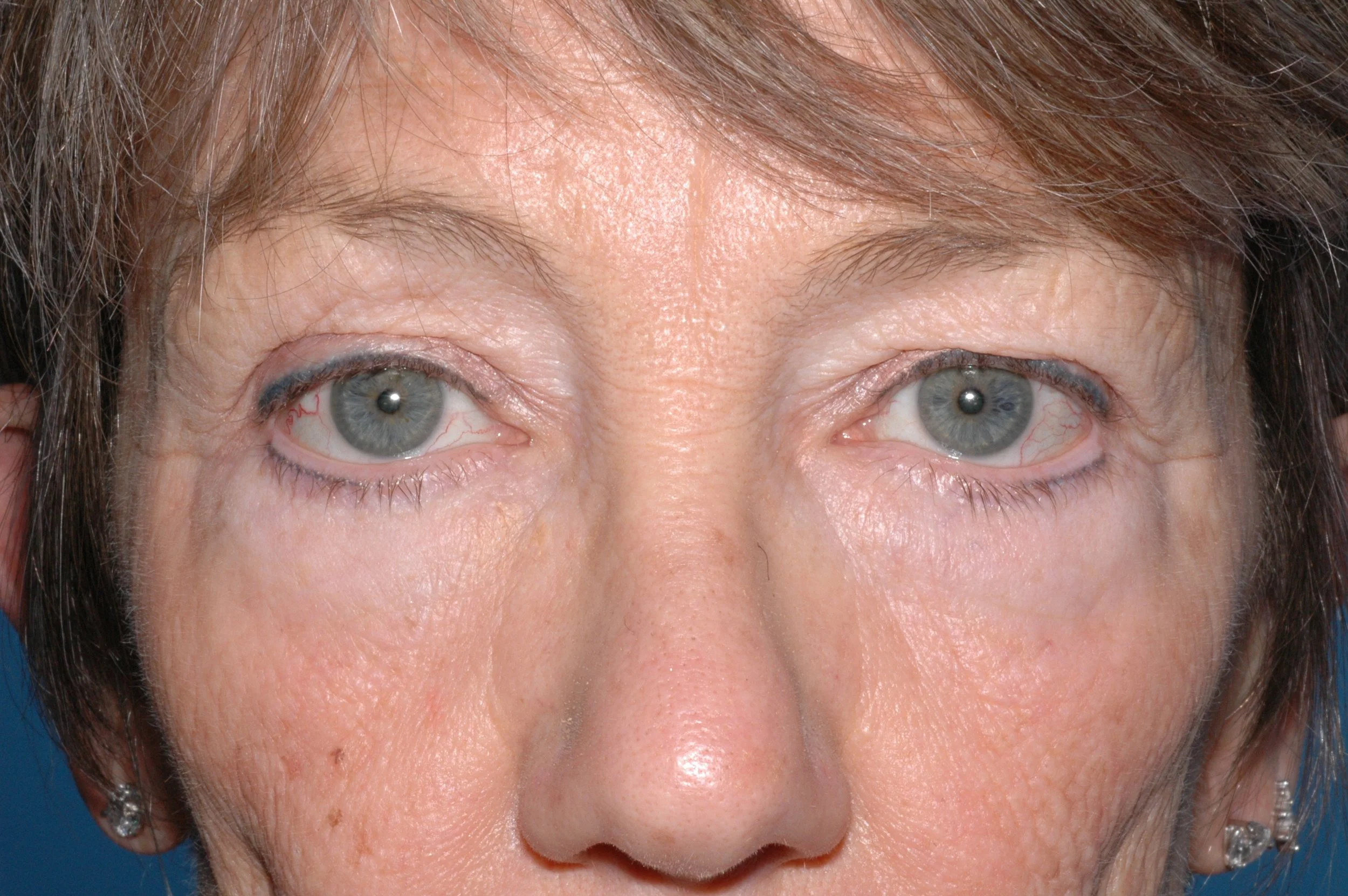 BEFORE: upper eyelid hooding