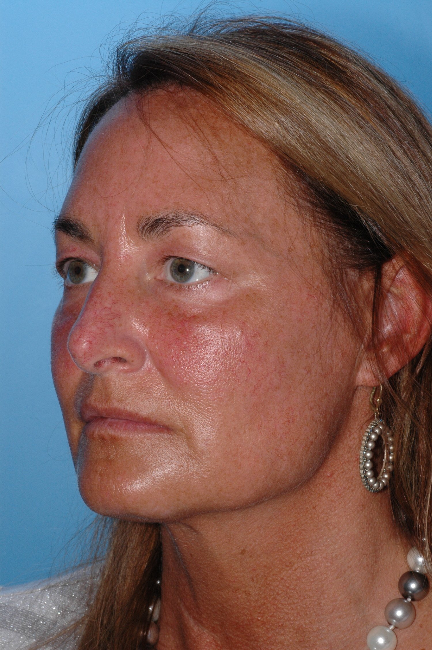 BEFORE upper eyelid blepharoplasty