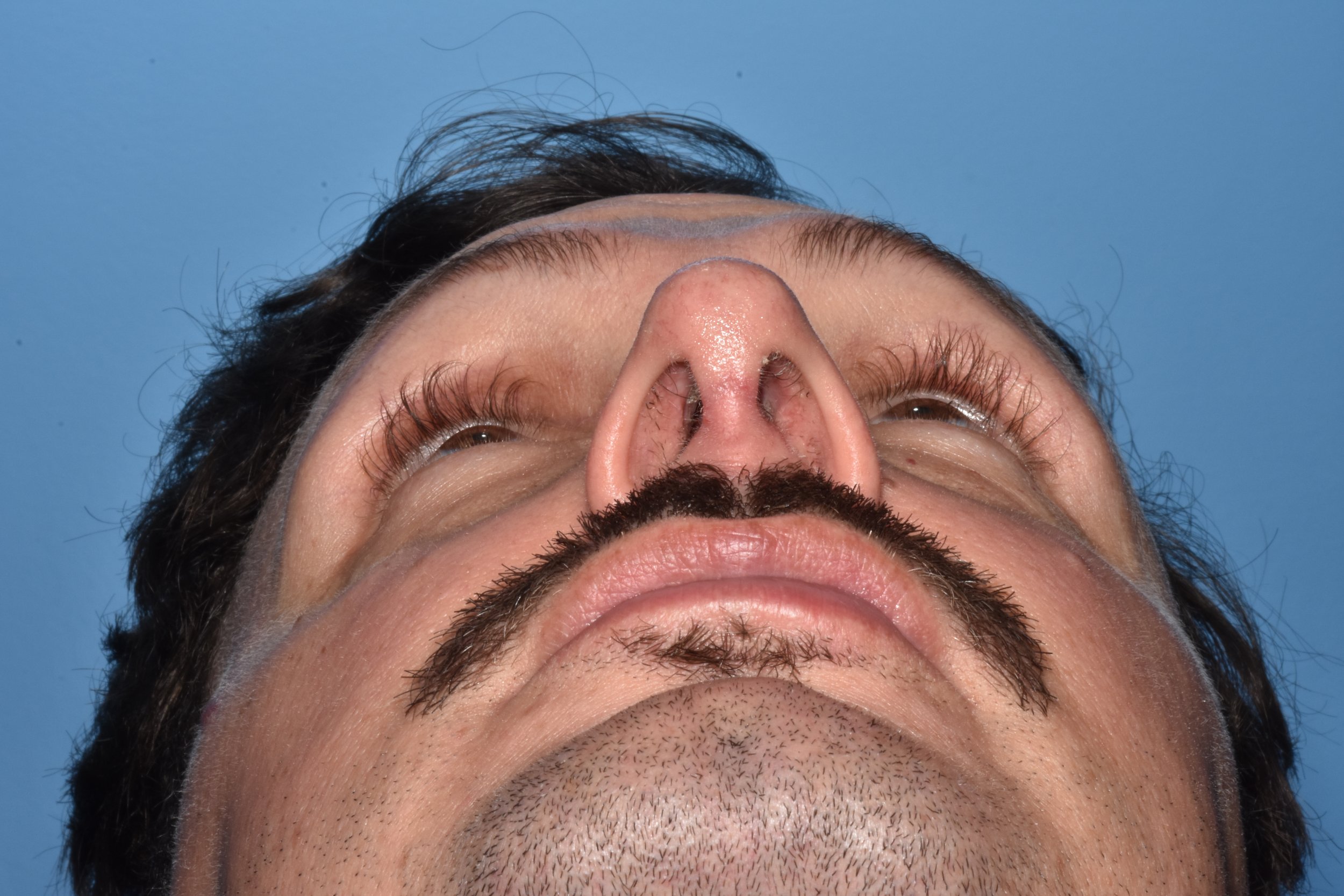 3m AFTER functional rhinoplasty: no collapse with inspiration