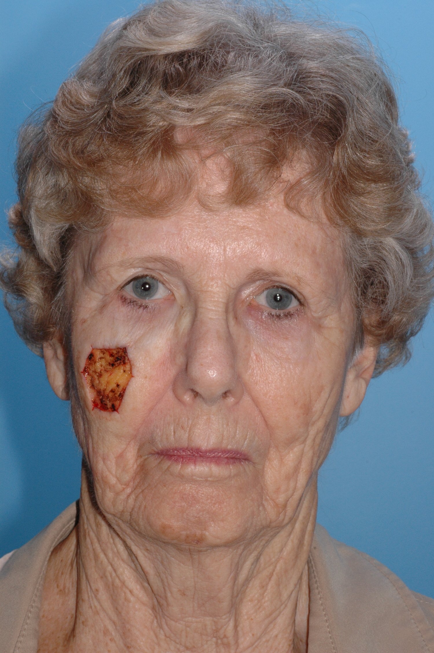 BEFORE: R lateral mid-face defect from Mohs