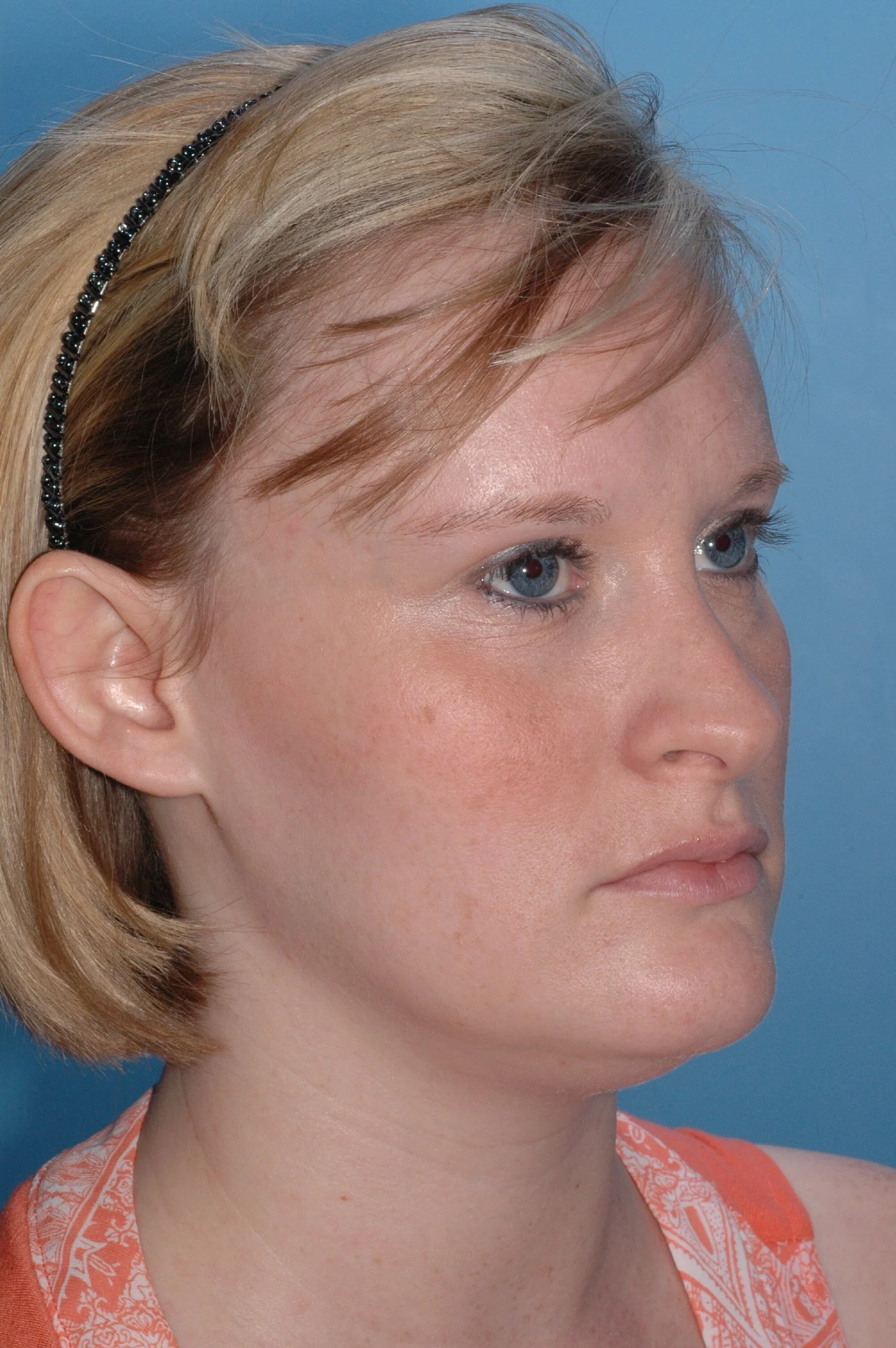 BEFORE R otoplasty