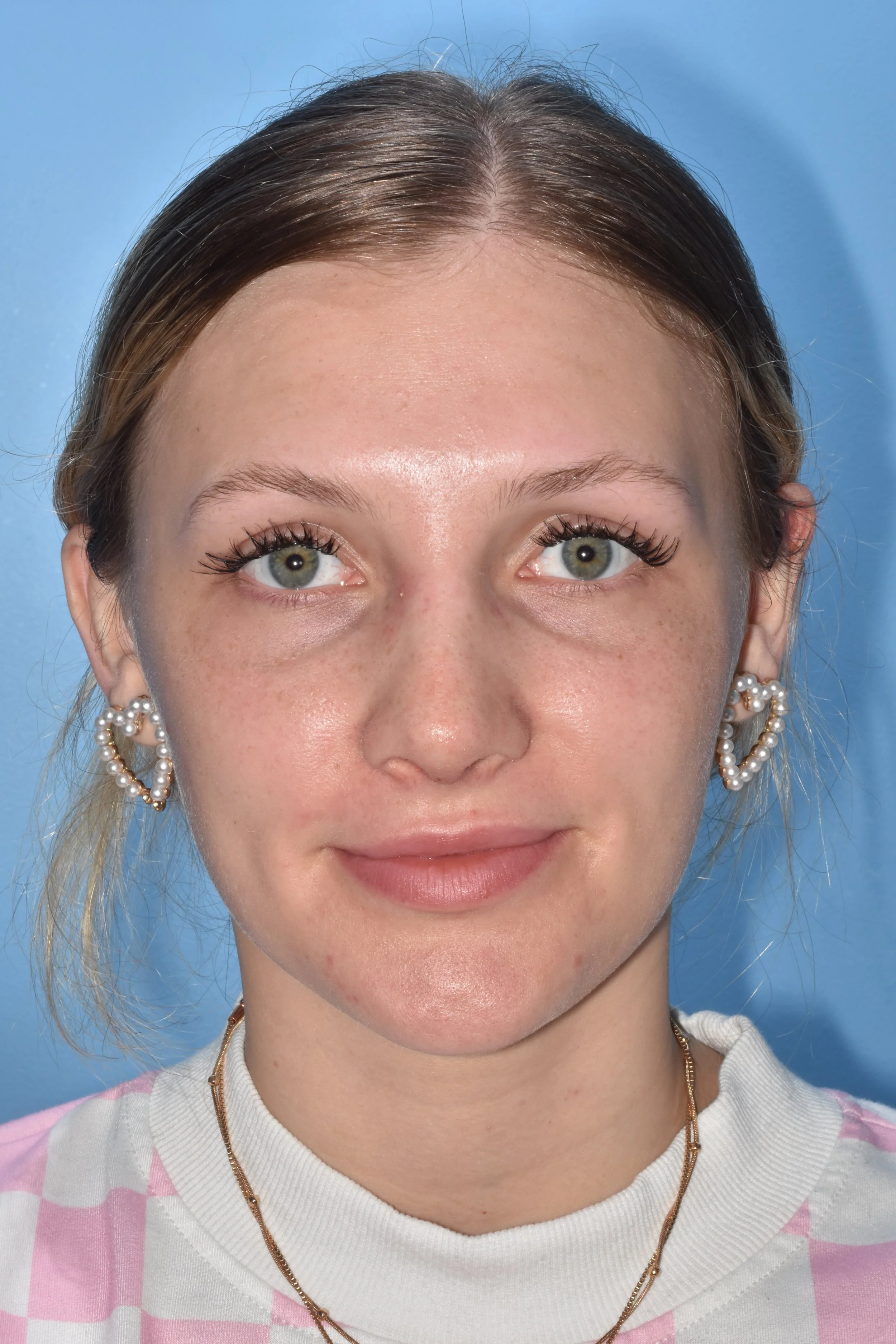 AFTER rhinoplasty (tip elevation, hump reduction)