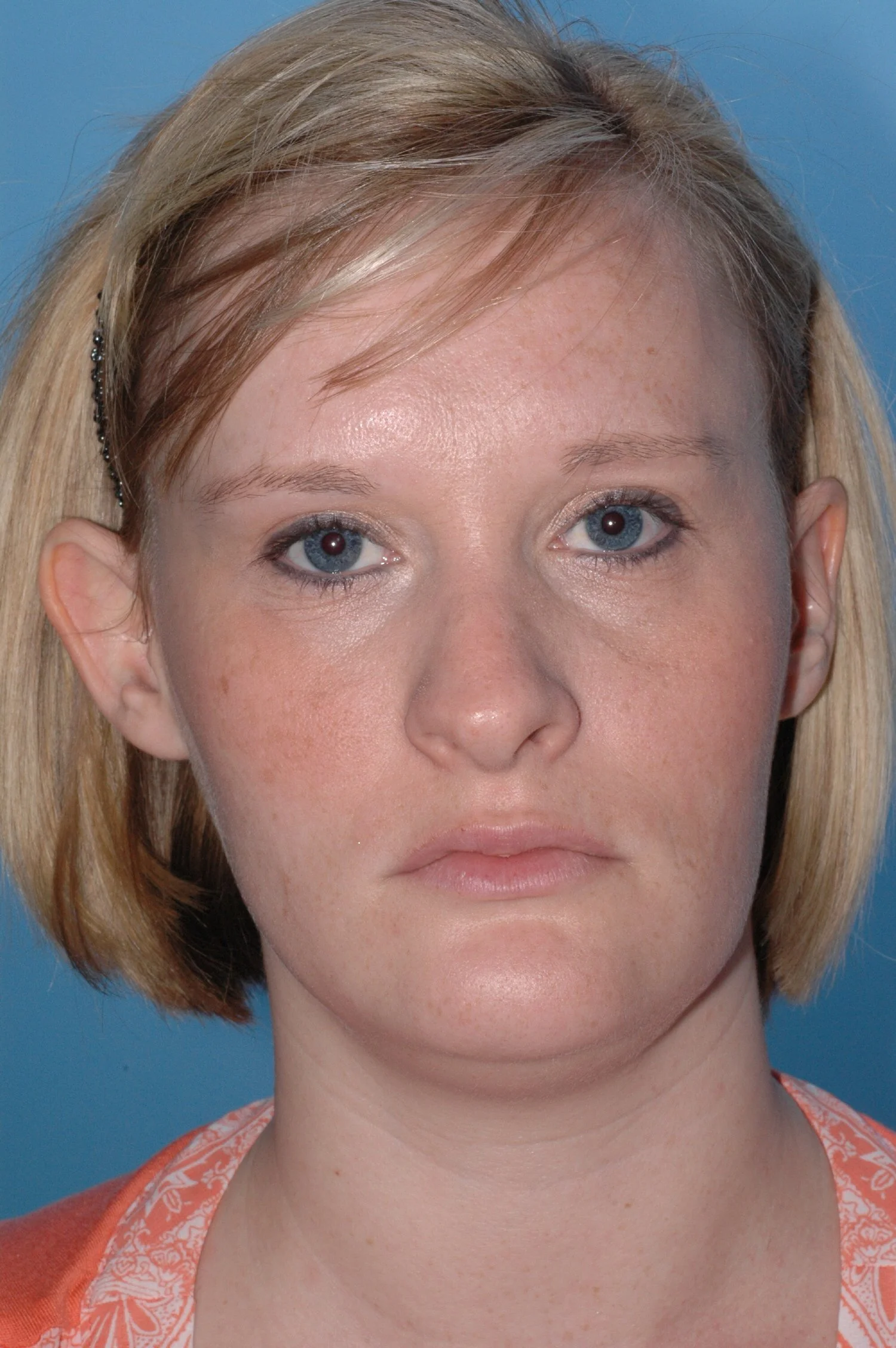 BEFORE R otoplasty