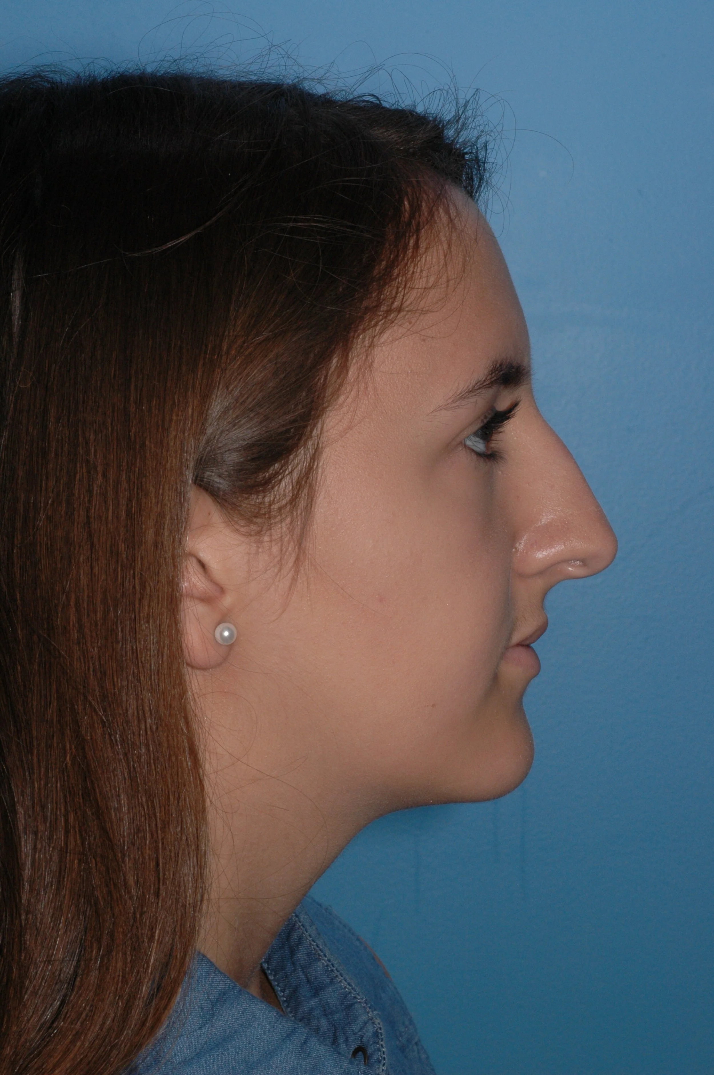 BEFORE rhinoplasty: wide nasal tip, wide dorsum, ptotic tip