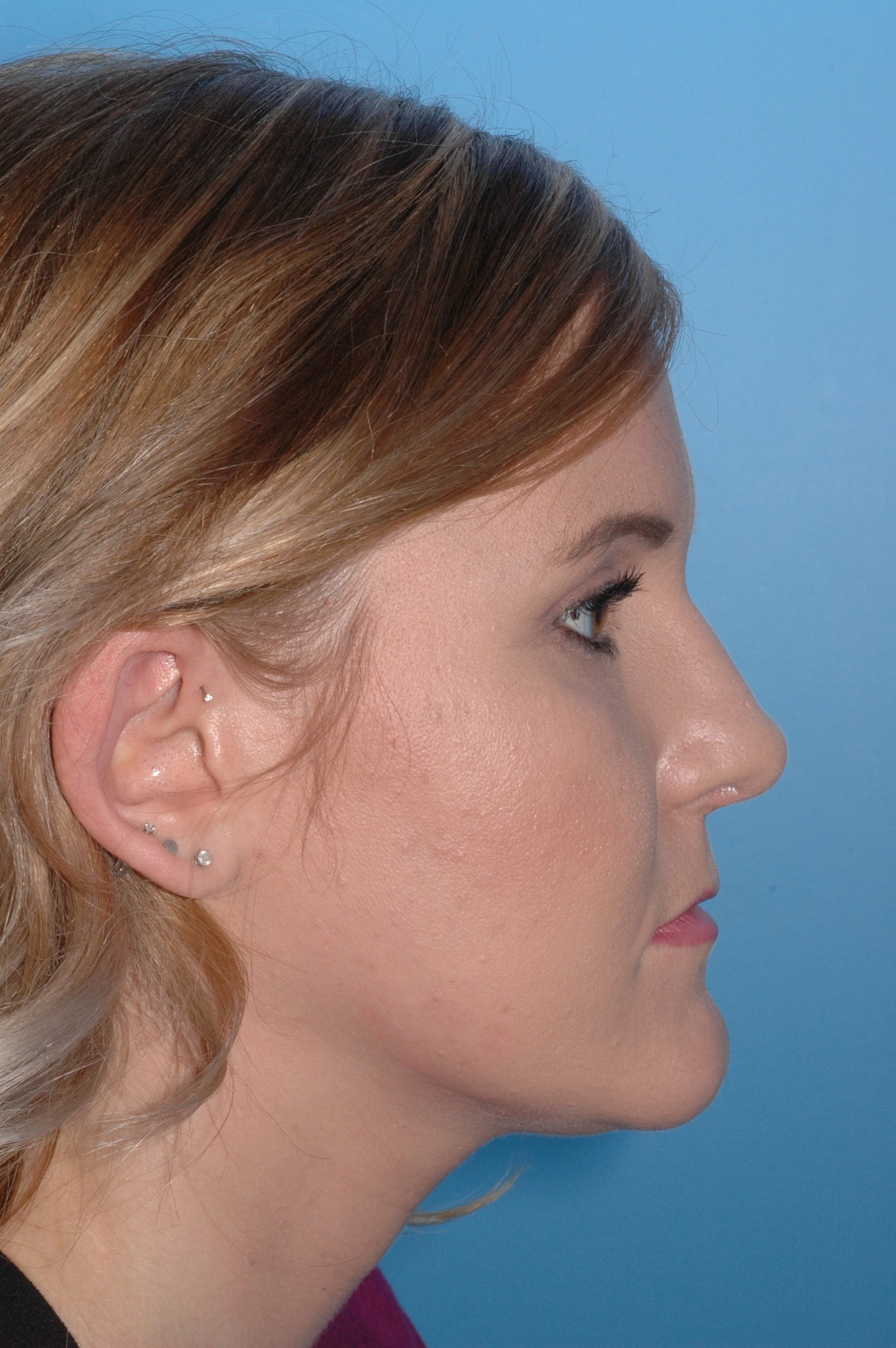 AFTER:  dorsal reduction, cephalic turn in to narrow tip, plumping graft placed in  the premaxilla region, tongue-in-groove for tip support,  clocking sutures