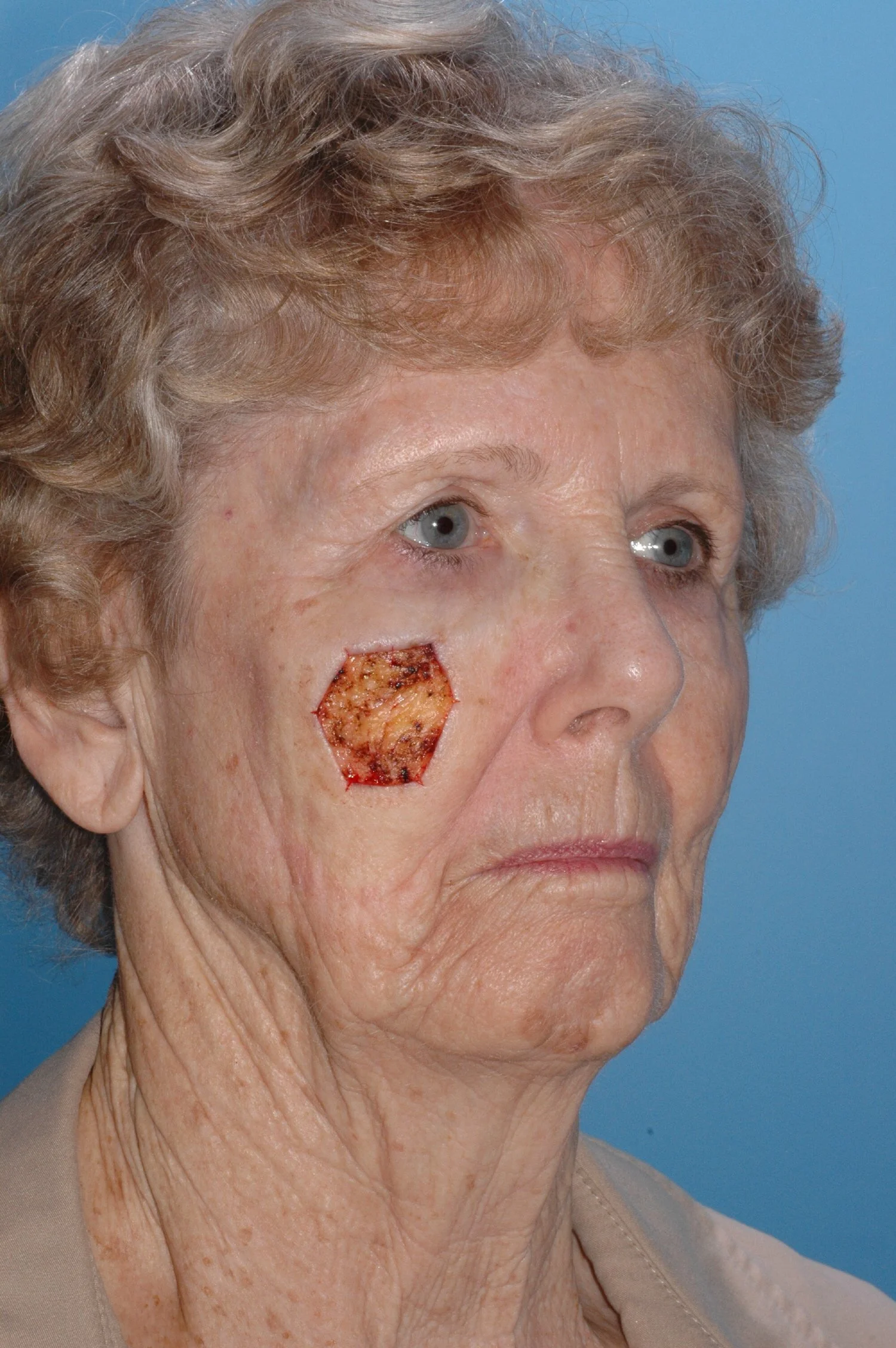 BEFORE: R lateral mid-face defect from Mohs