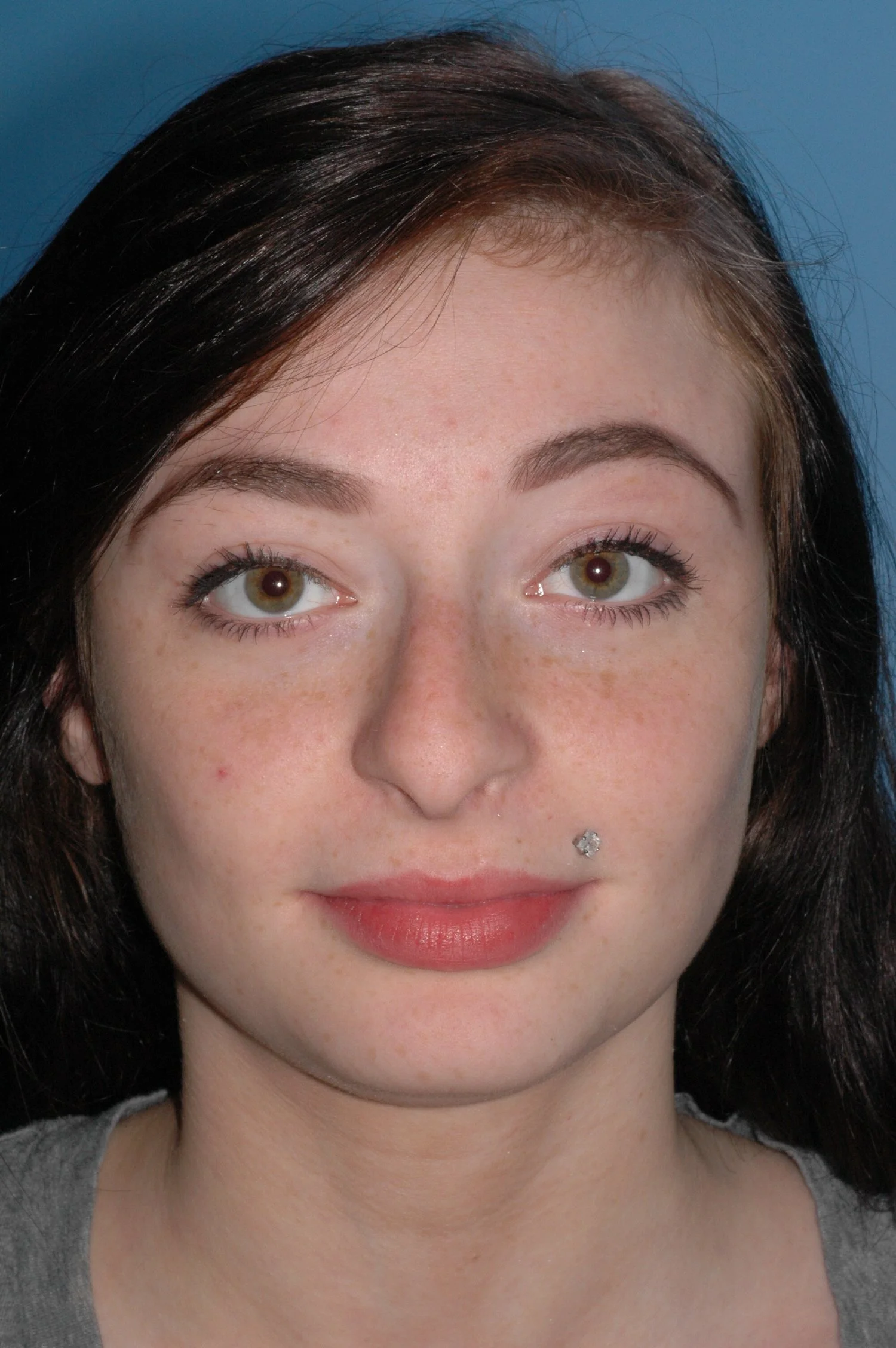 BEFORE rhinoplasty: droopy nasal tip, nasal hump