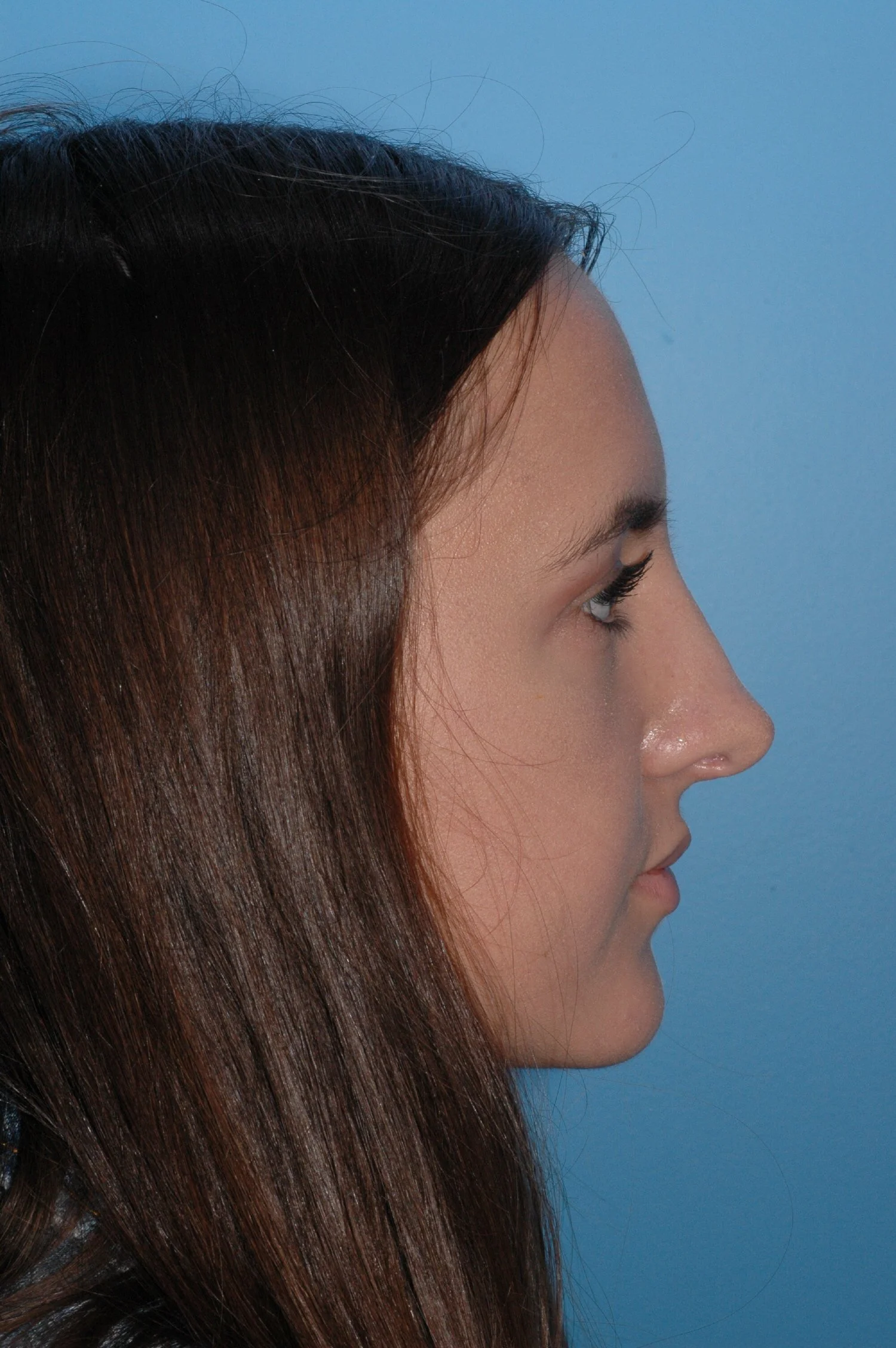 4 y AFTER rhinoplasty: dorsal reduction, tip narrowing, tip elevation