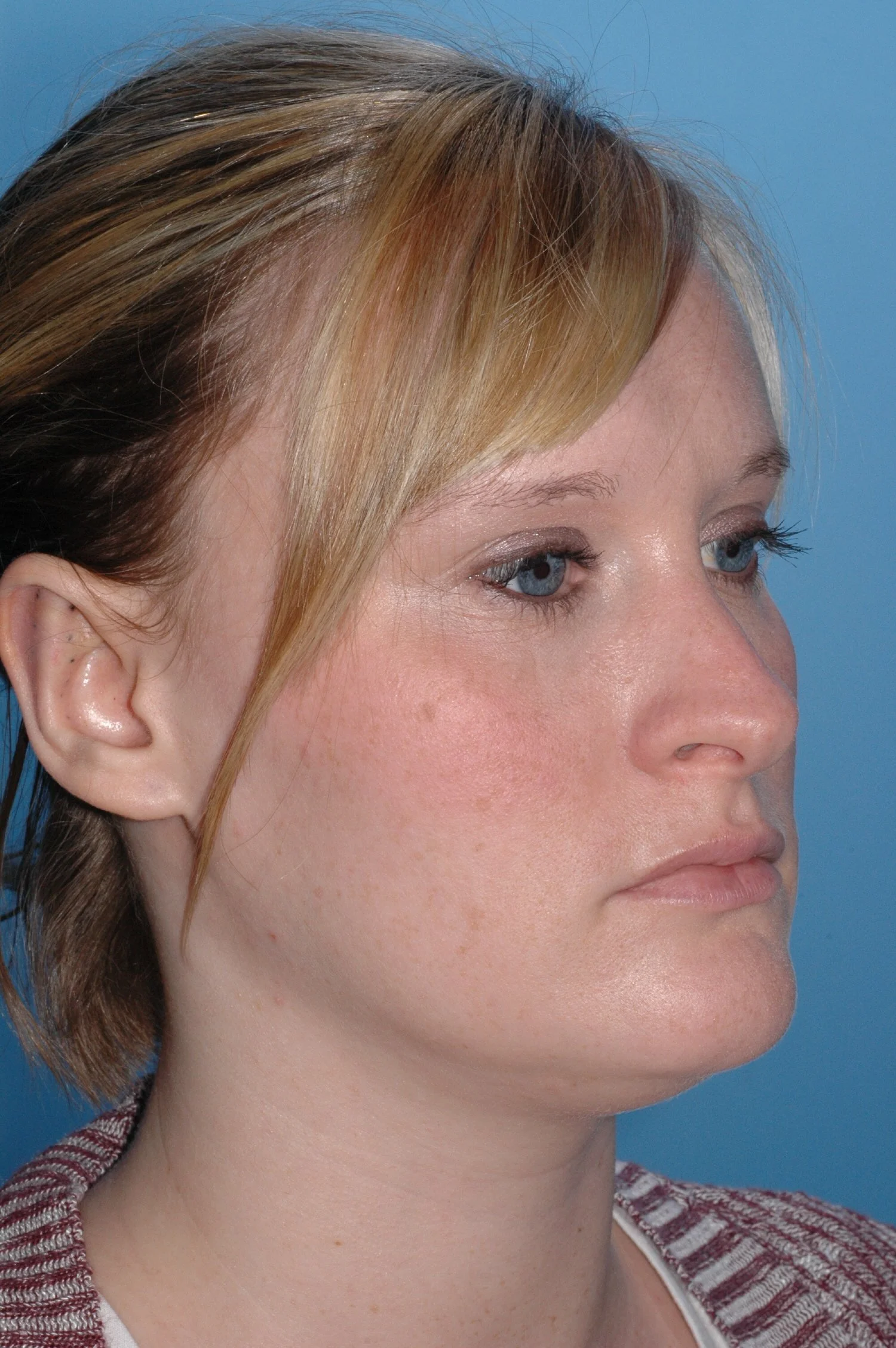 AFTER R otoplasty