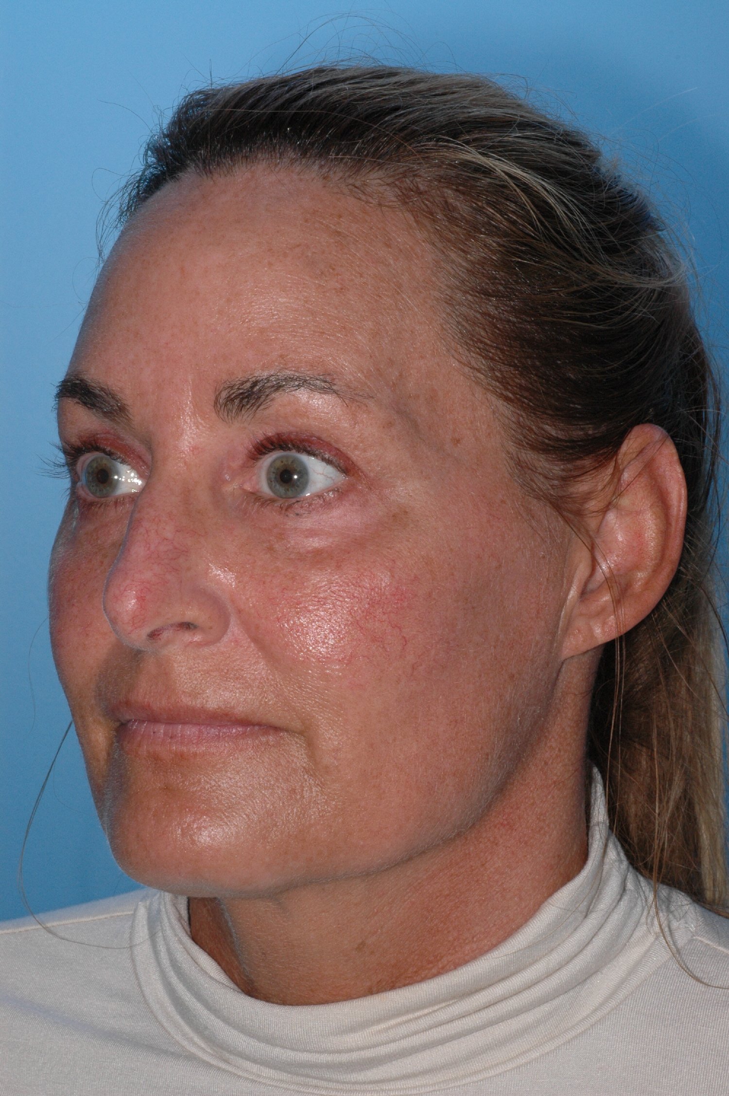 AFTER upper eyelid blepharoplasty