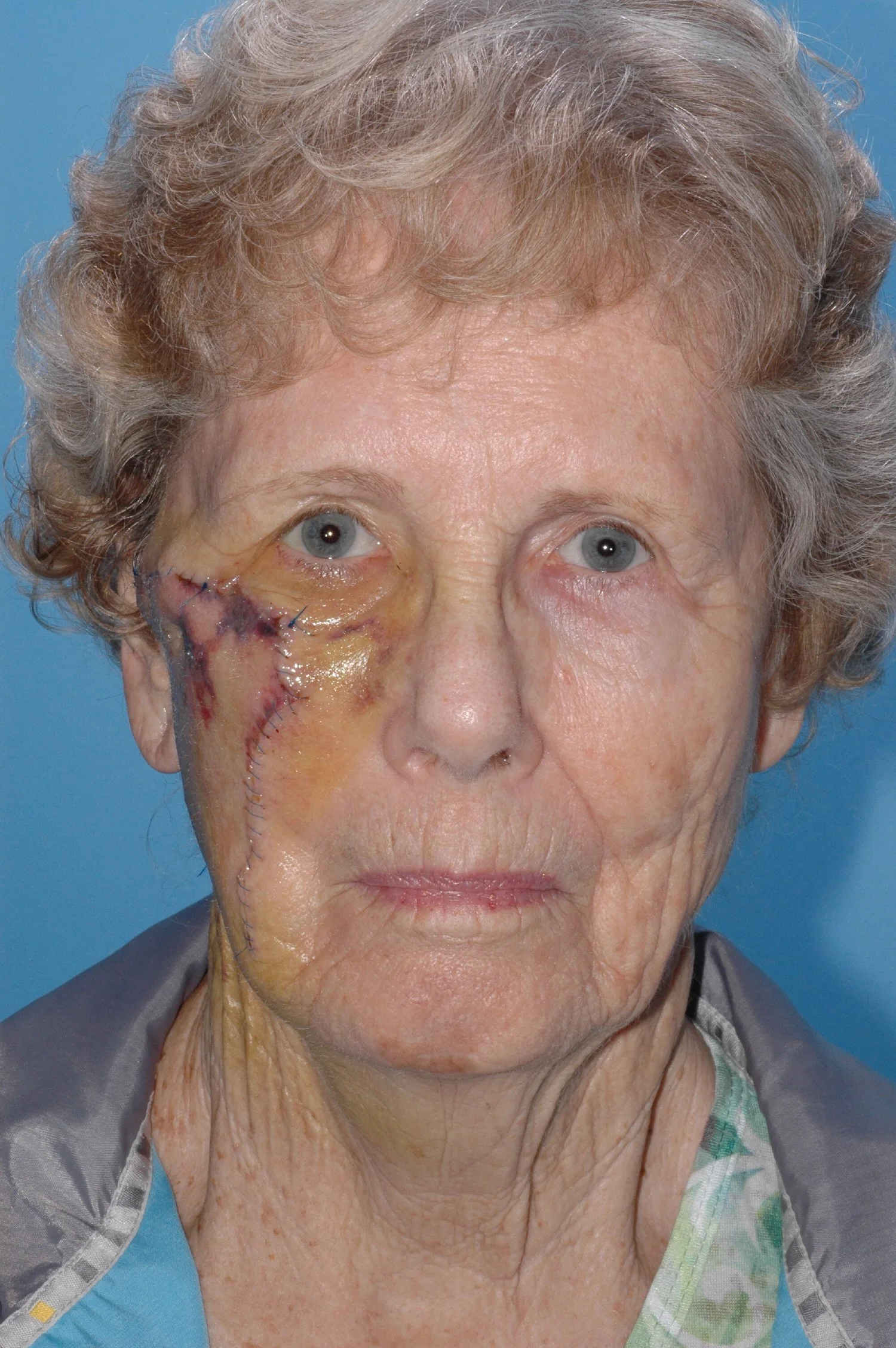 1 wk AFTER: cervical facial rotation flap