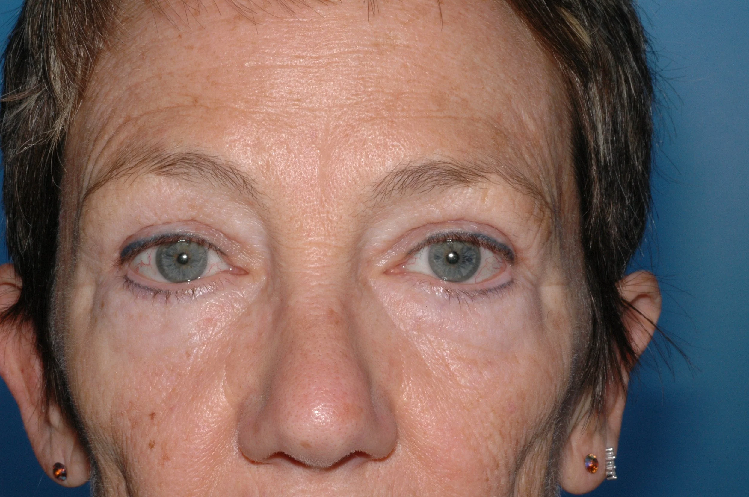 AFTER: upper eyelid blepharoplasty