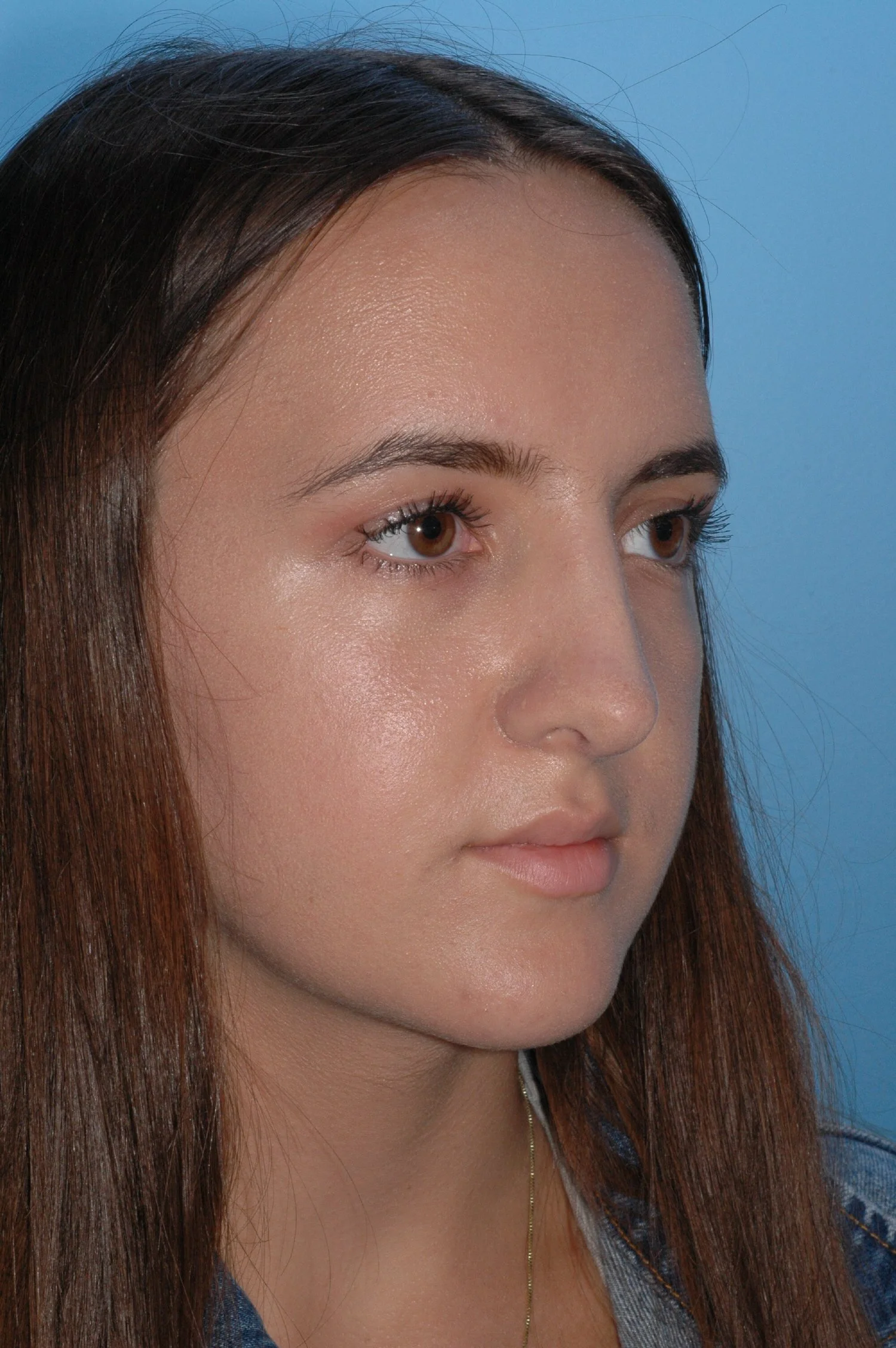 4 y AFTER rhinoplasty: dorsal reduction, tip narrowing, tip elevation