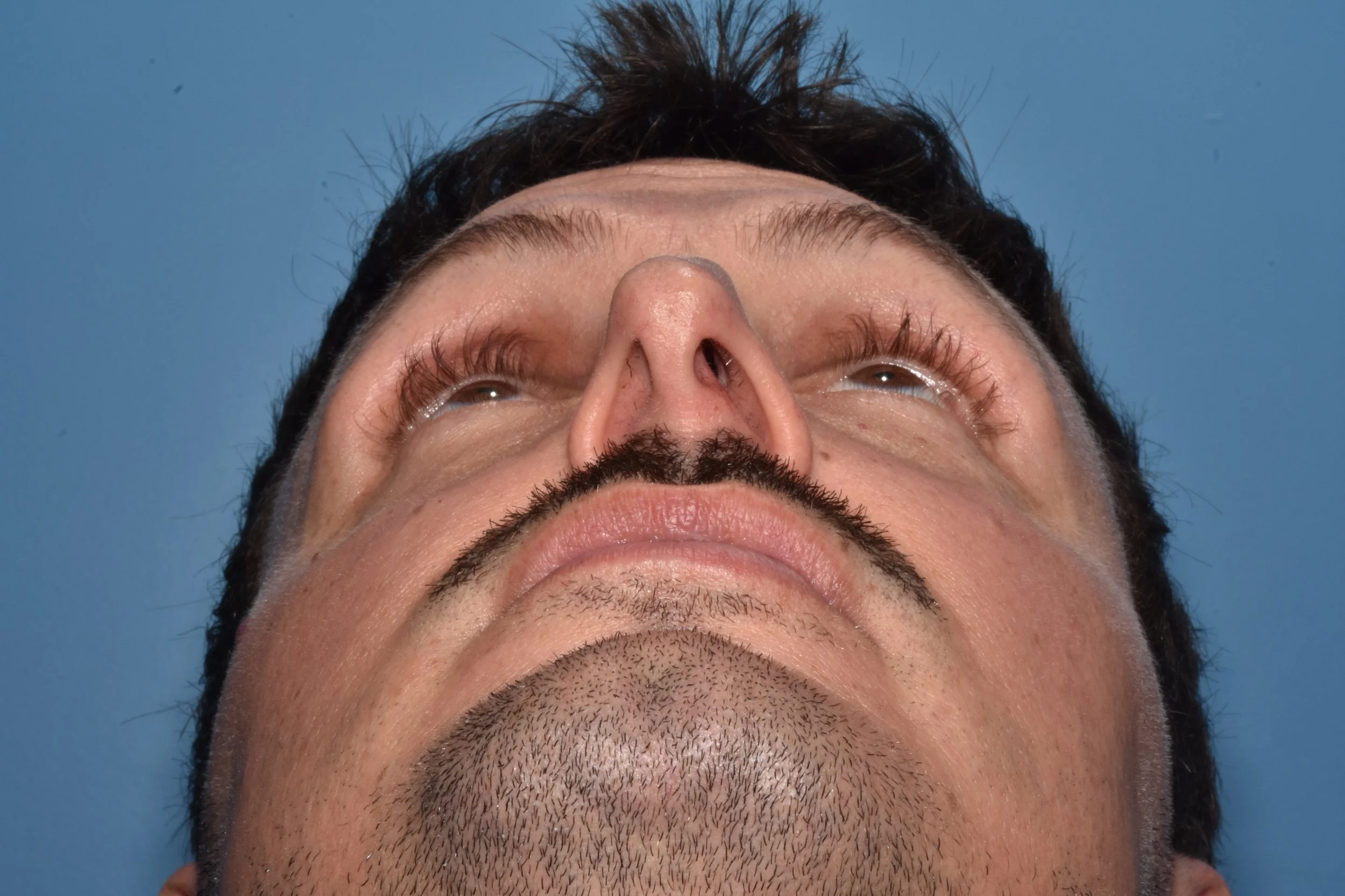 BEFORE (twisted nasal tip, concave lateral crura, external nasal valve collapse)