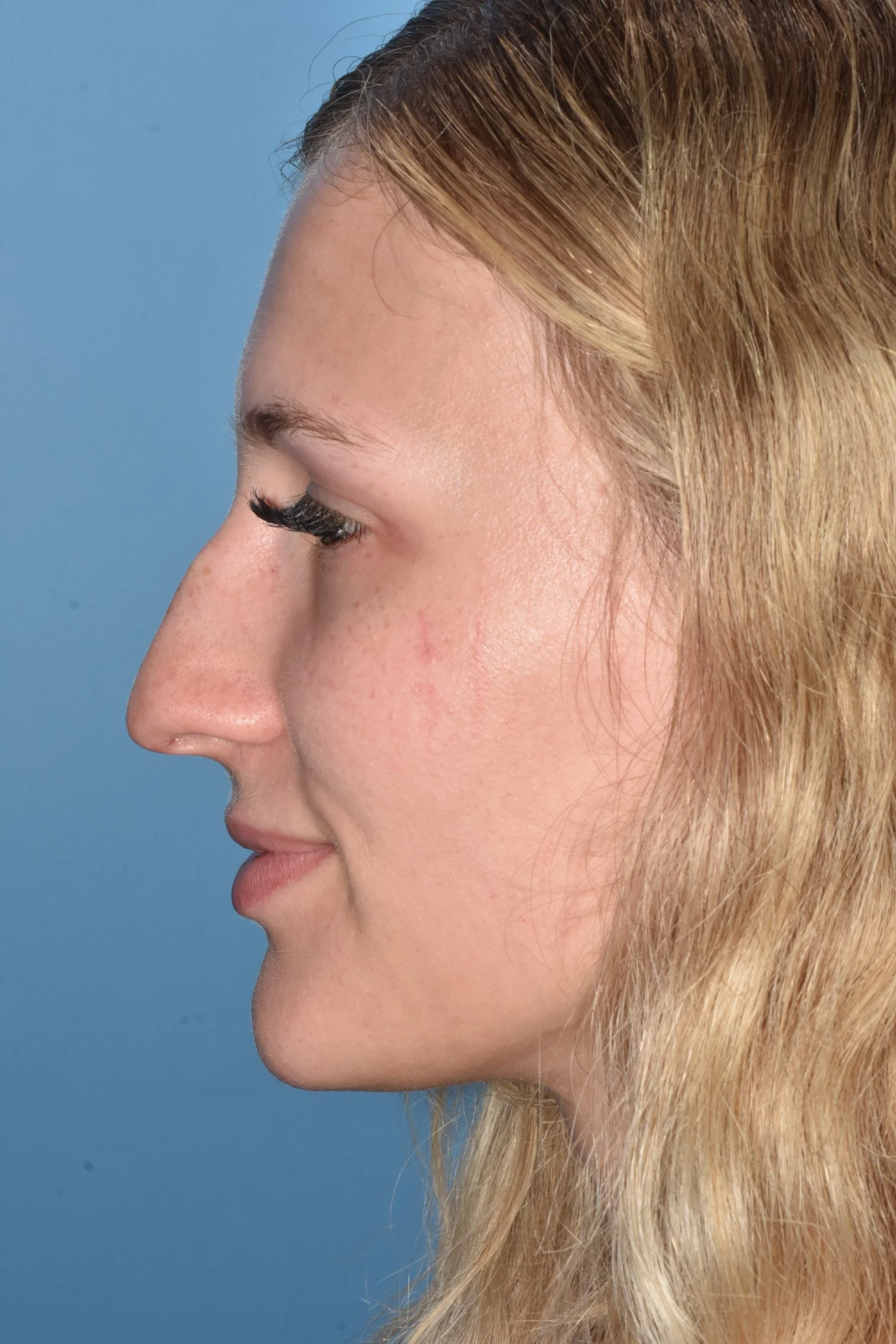 BEFORE rhinoplasty
