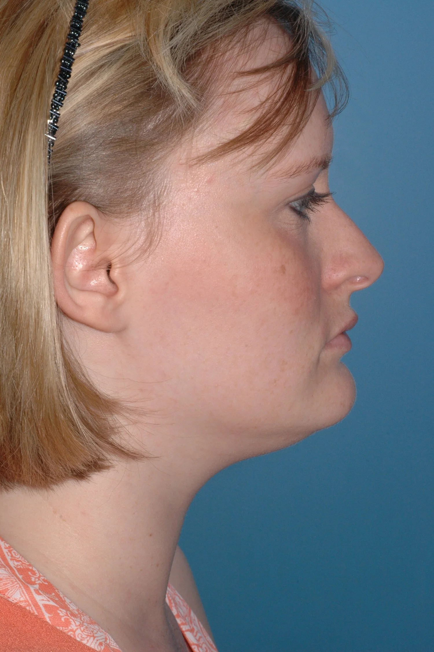 BEFORE R otoplasty