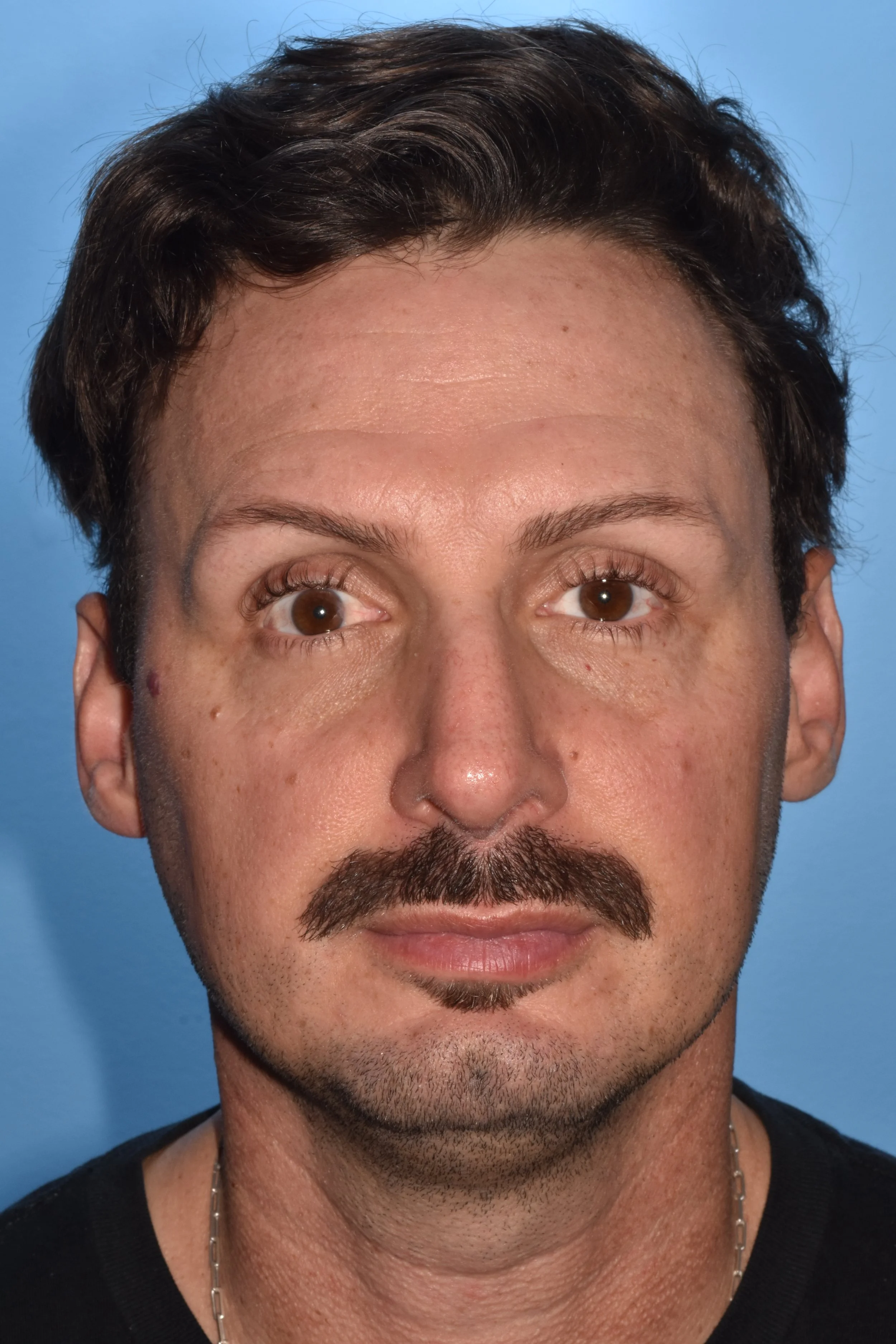 3m AFTER functional rhinoplasty: flatten/strengthen lateral crura, R spreader graft