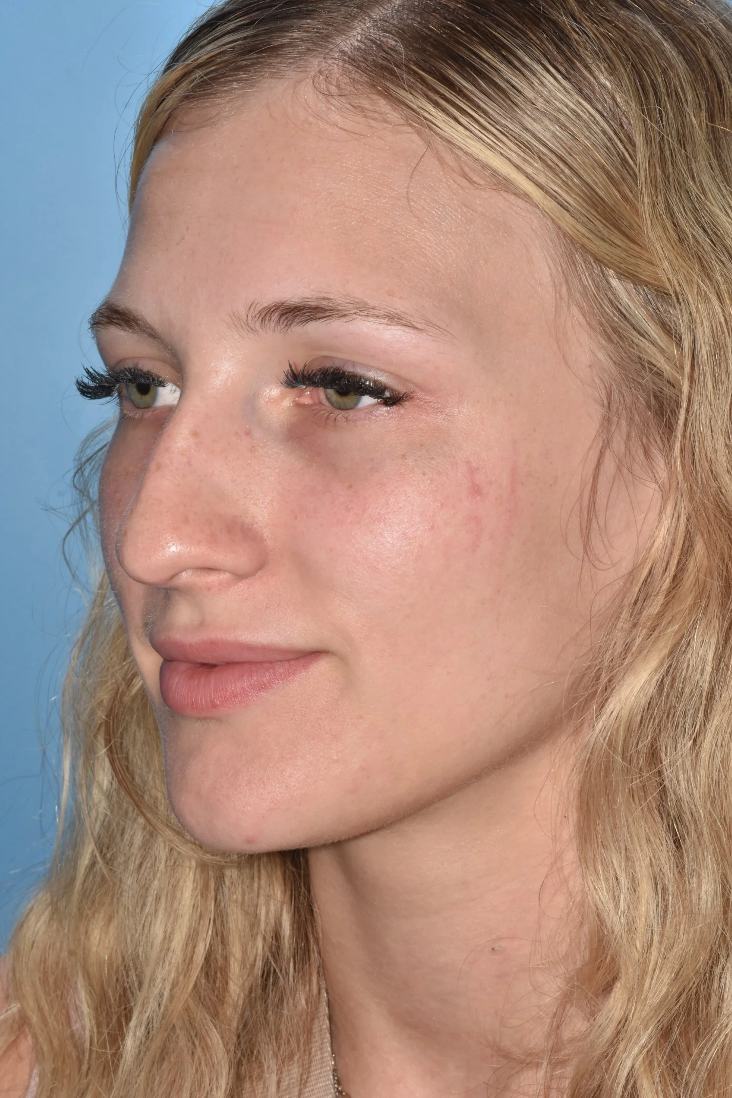 BEFORE rhinoplasty
