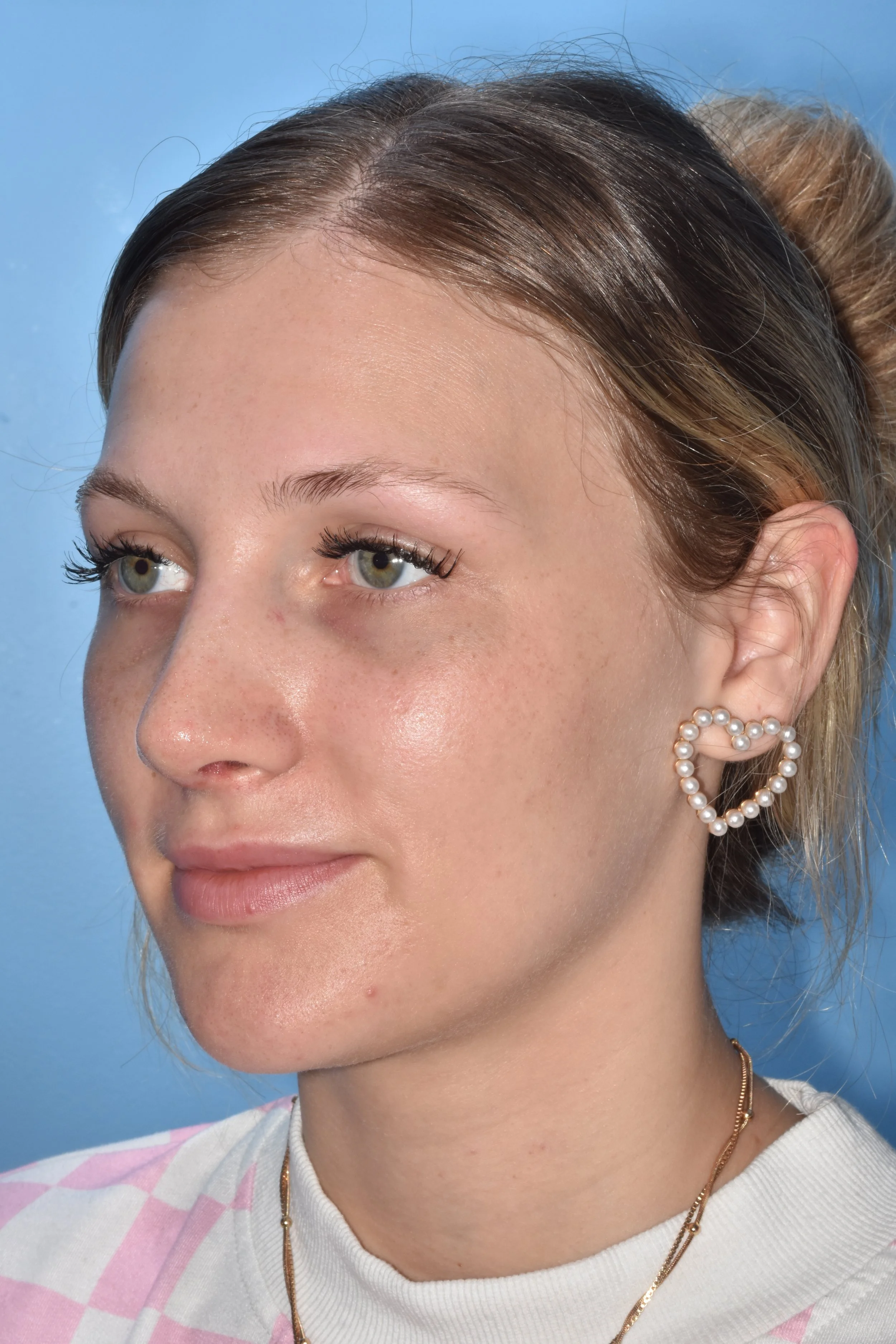 AFTER rhinoplasty (tip elevation, hump reduction)