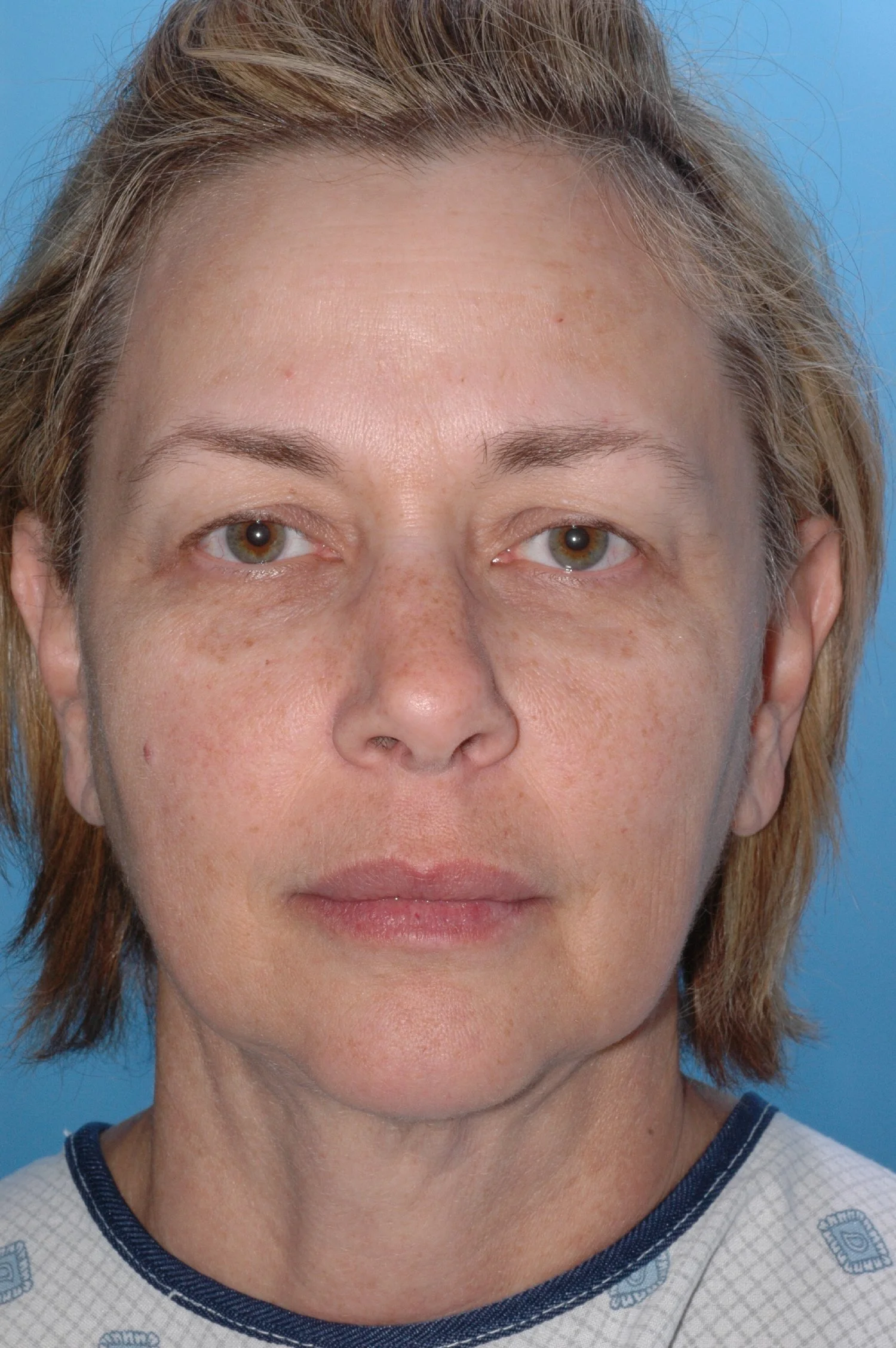 BEFORE Upper lid blepharoplasty