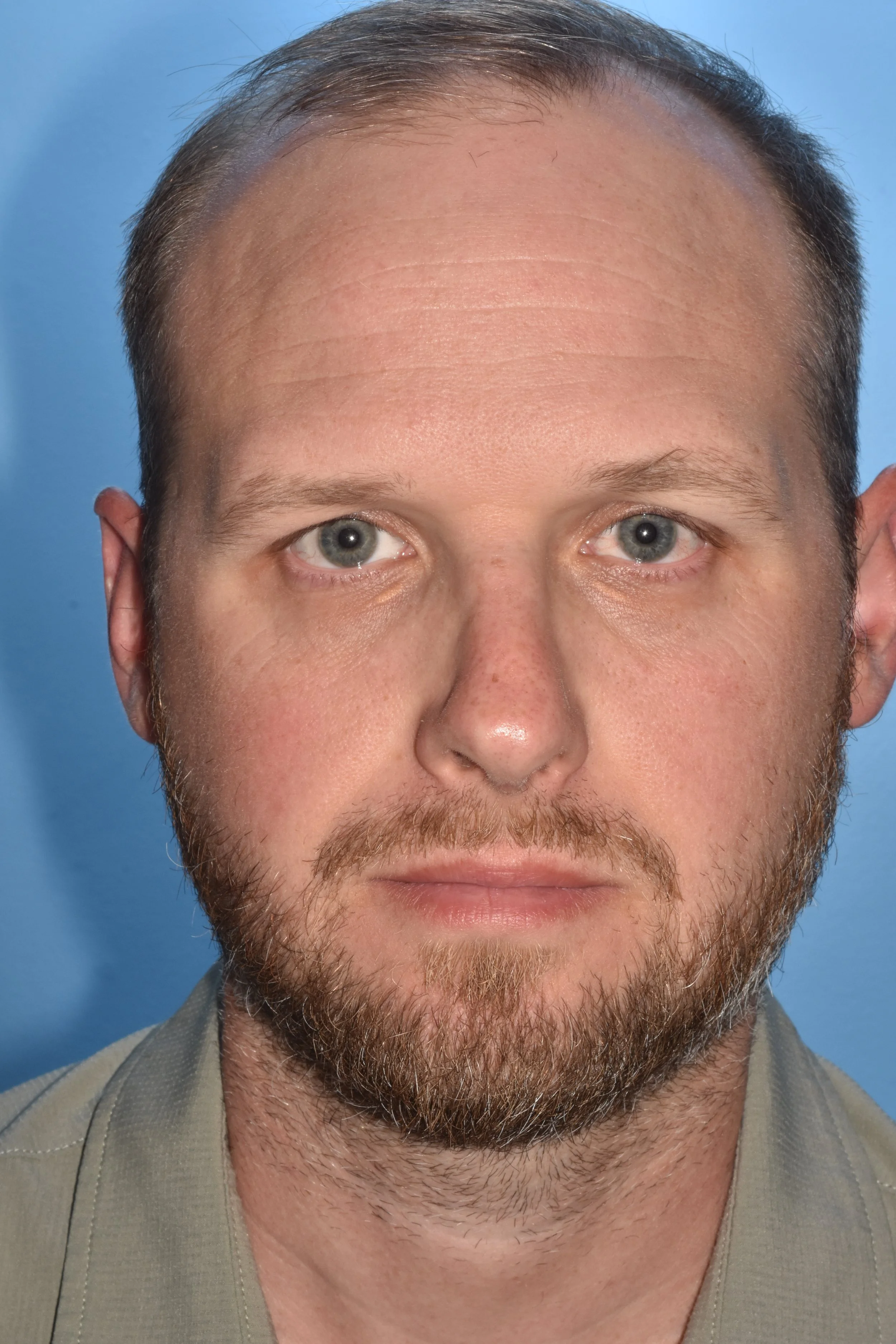 AFTER functional rhinoplasty (reduce tip twist, center caudal septum)