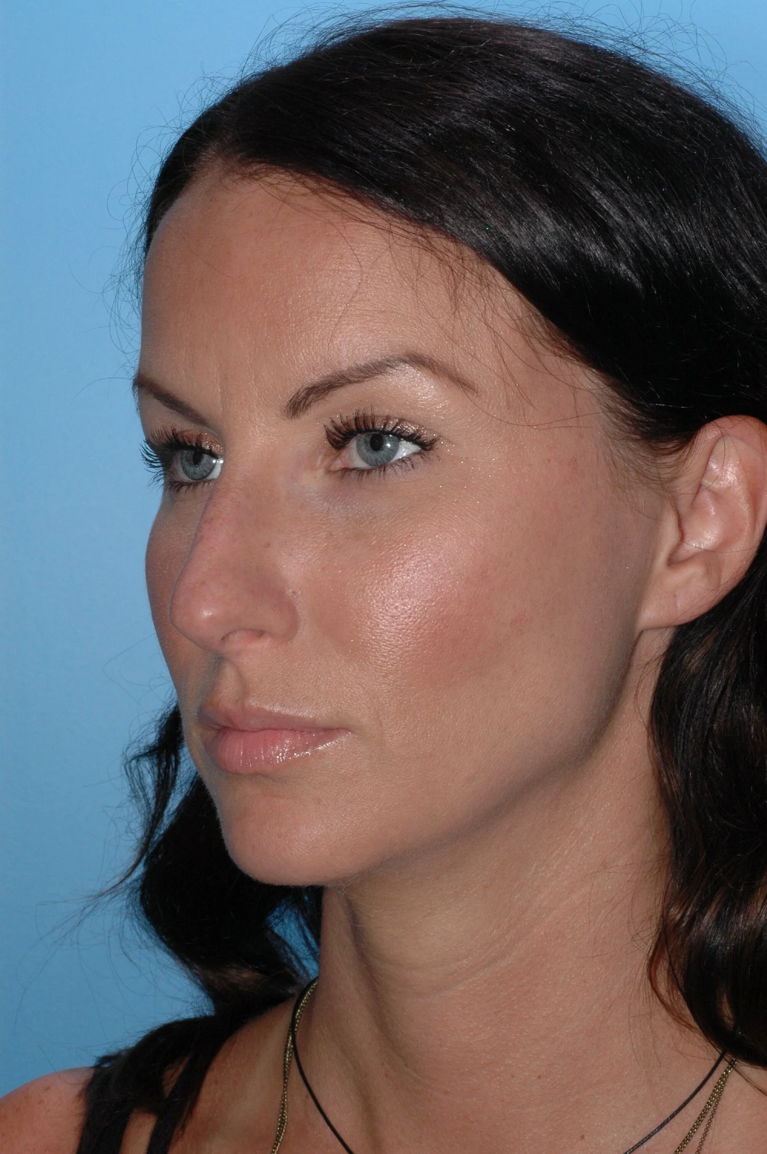 BEFORE rhinoplasty (overprojected dorsum,  functional issues)