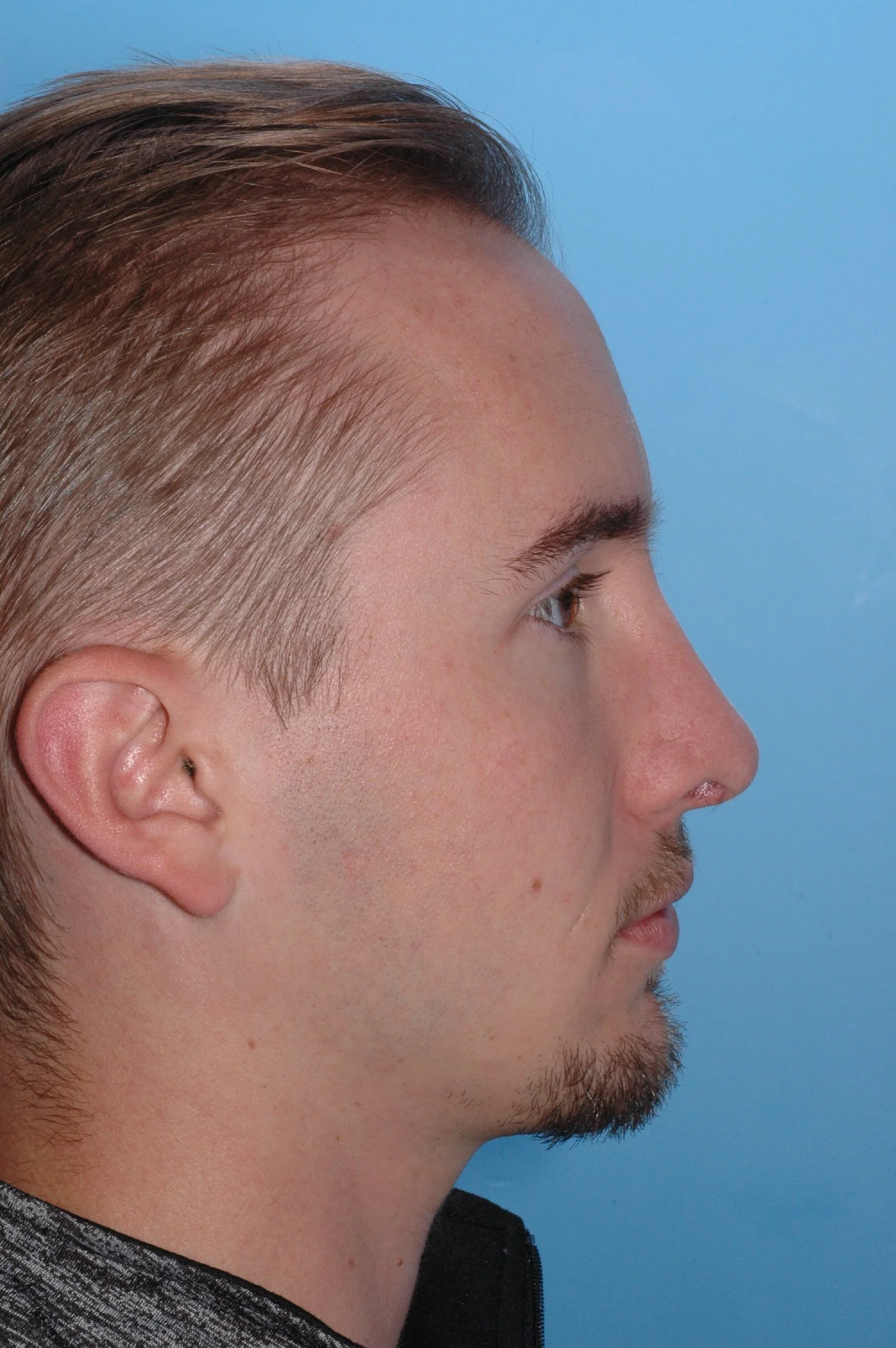 AFTER rhinoplasty: Double PDS
foil placed on the left side after weakening the cartilage to conform to it, nasal dorsum reduced, L cephalic turn-in, R cephalic trim, .
1.5 mm lateral crural overlap, bossae
softened over right tip-defining point, crus