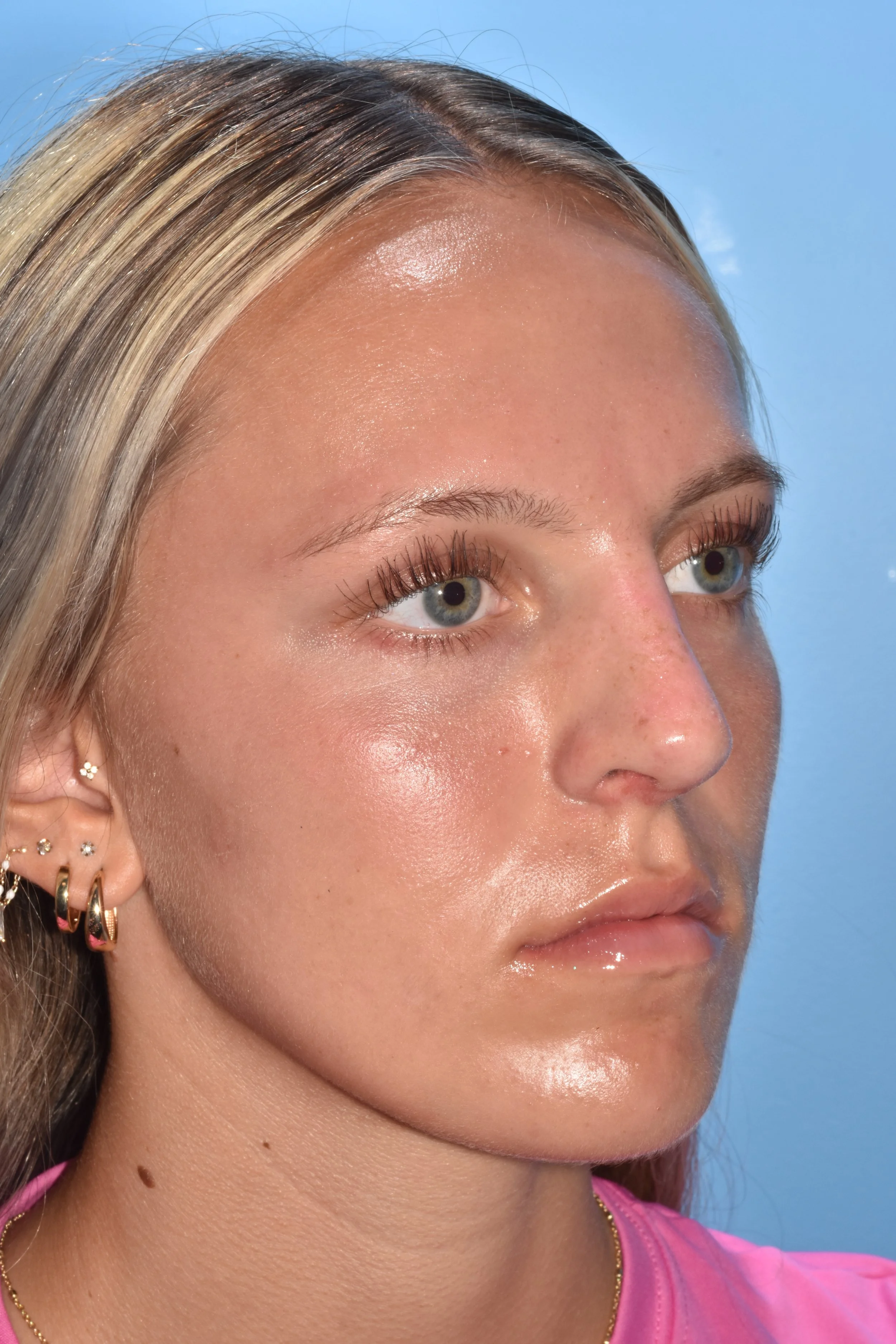 AFTER Rhinoplasty (dorsal reduction, eliminate soft tissue triangle depression at nostril apex) 