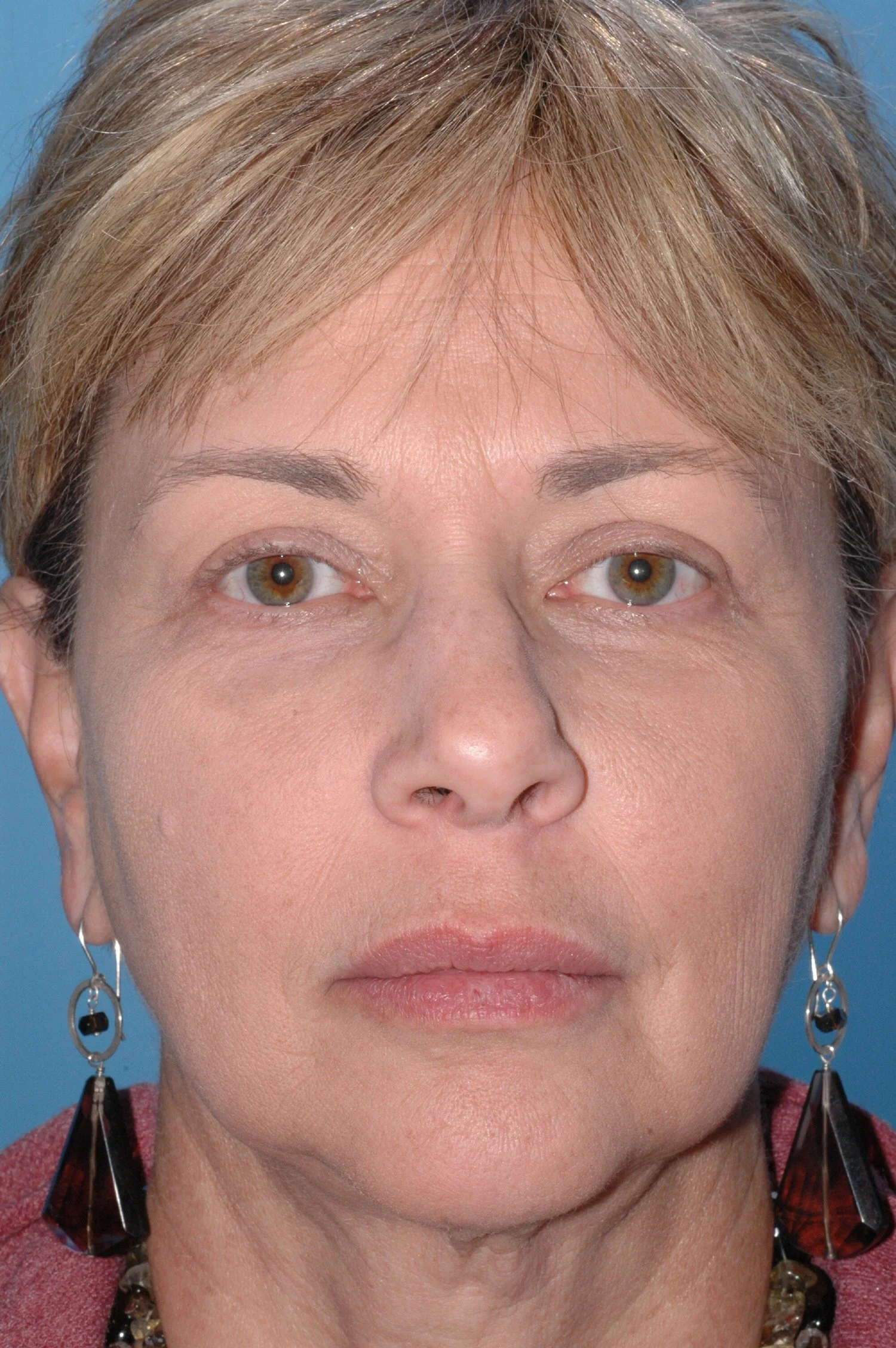 AFTER Upper lid blepharoplasty; notice increased "platform" show above the lash line.
