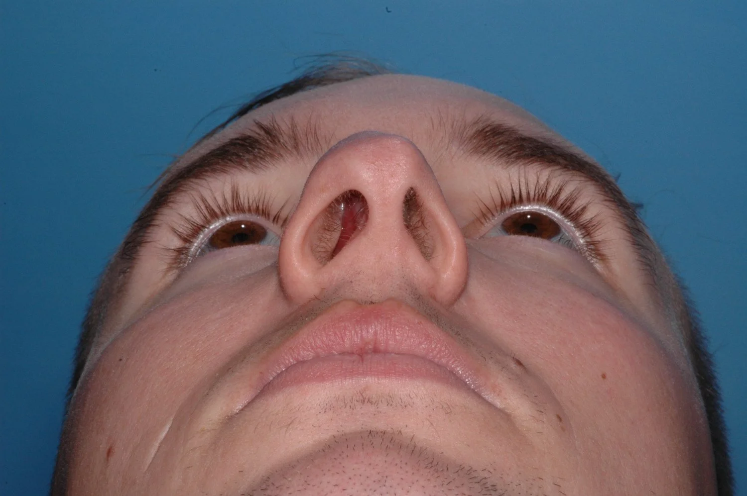 BEFORE rhinoplasty: tip twisted to L, dorsal hump, nostril asymmetry