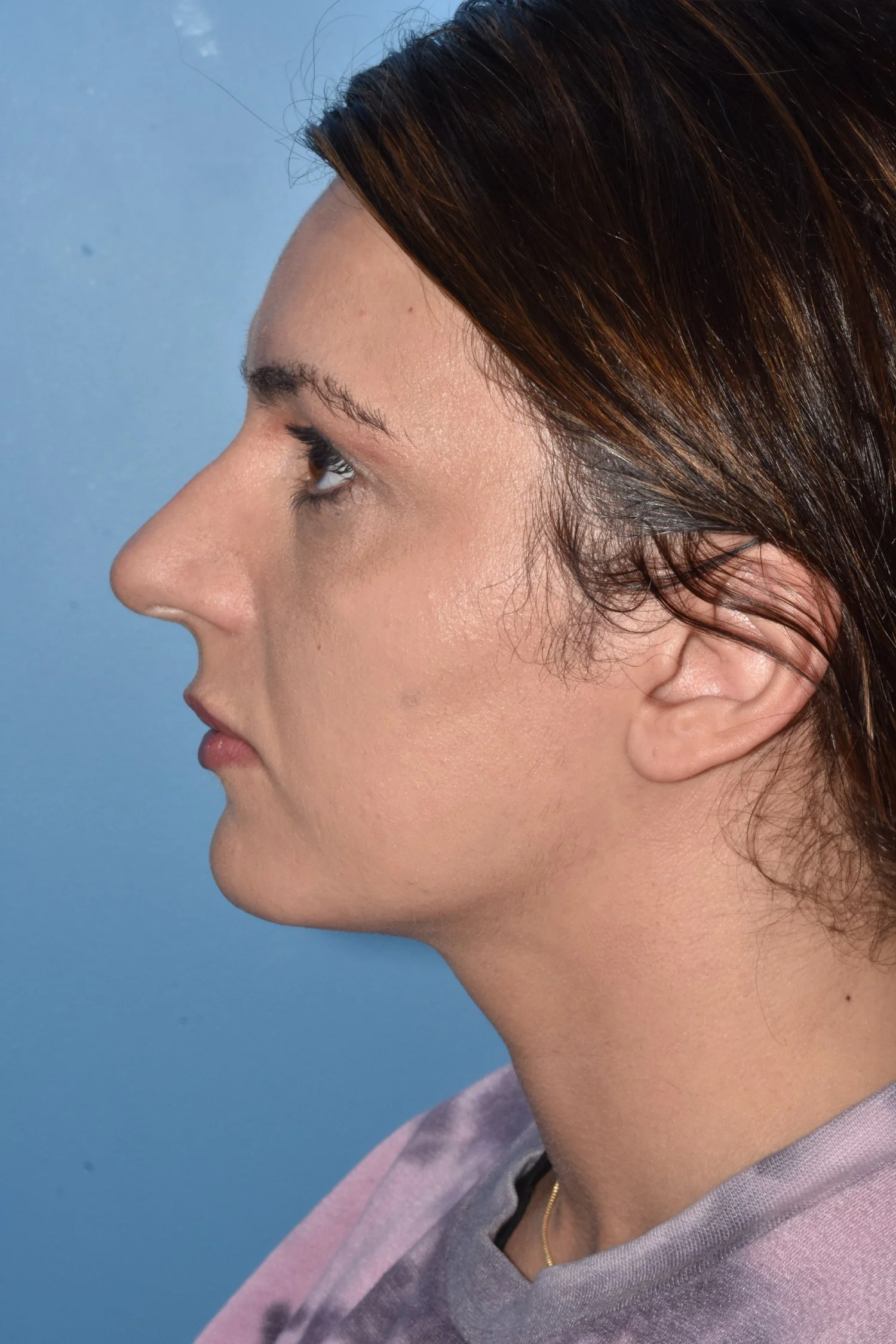 BEFORE rhinoplasty