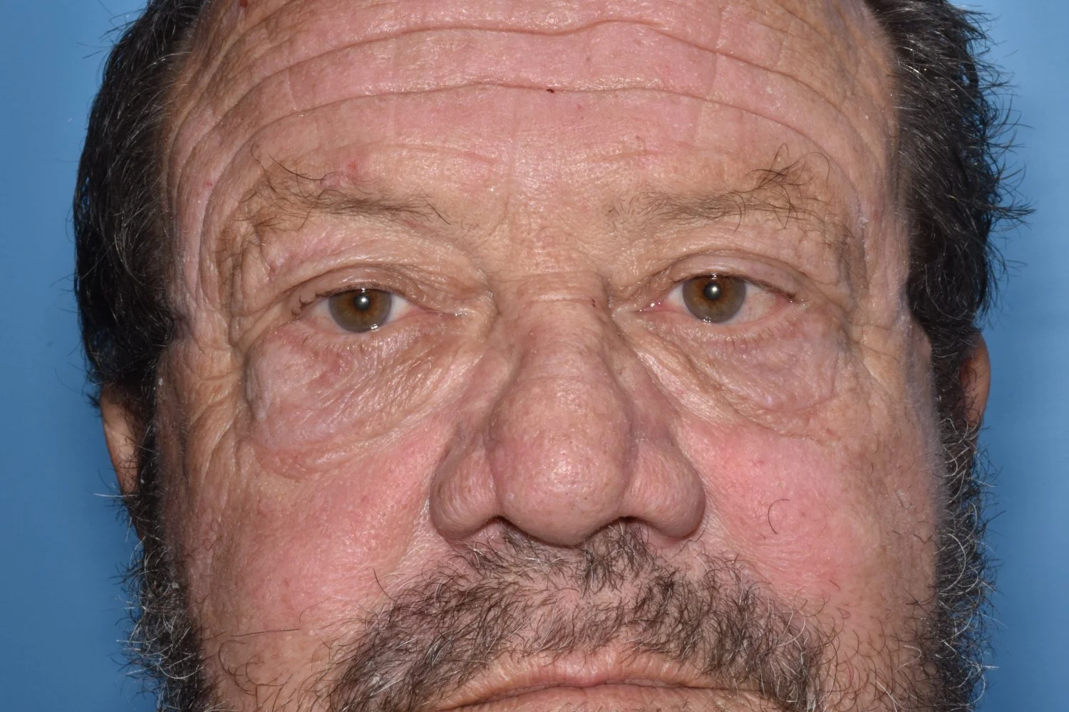 AFTER: excision of lower lid festoons, cathopexy