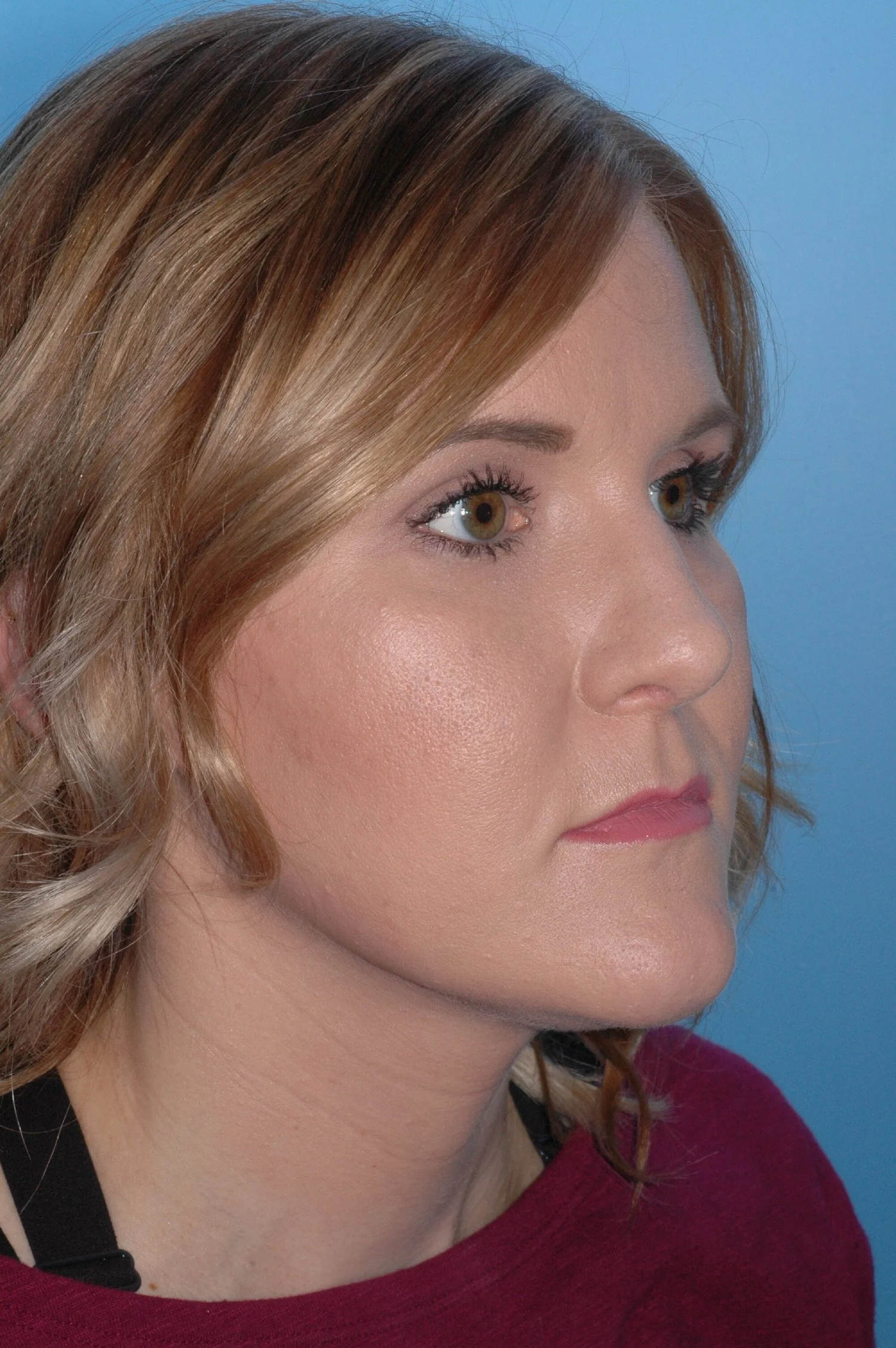 AFTER:  dorsal reduction, cephalic turn in to narrow tip, plumping graft placed in  the premaxilla region, tongue-in-groove for tip support,  clocking sutures