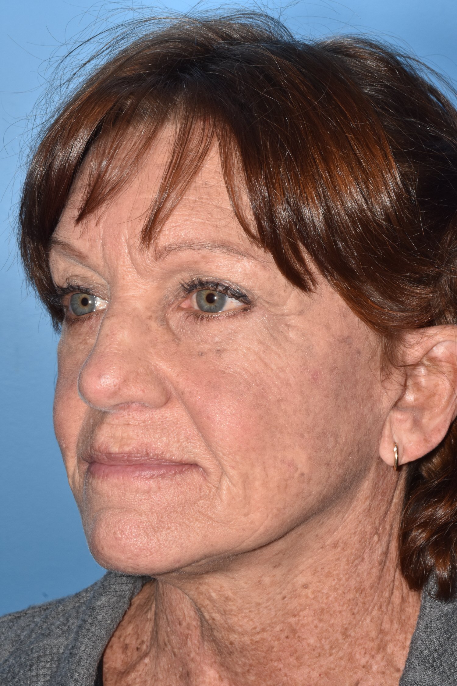 AFTER: deep plane face lift, fat reposition lower lid blepharoplasty