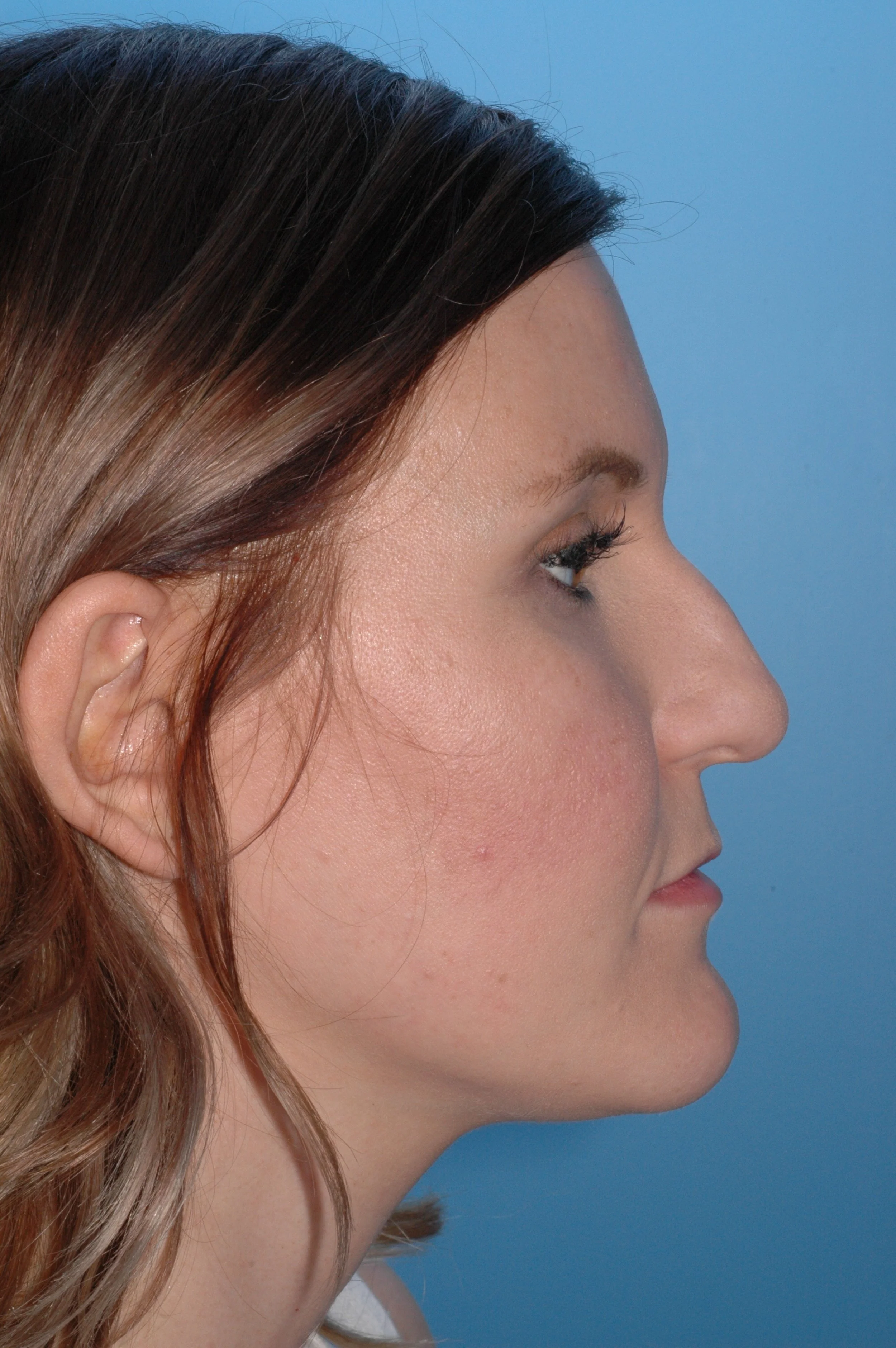 BEFORE: Crooked nose, hump dorsum